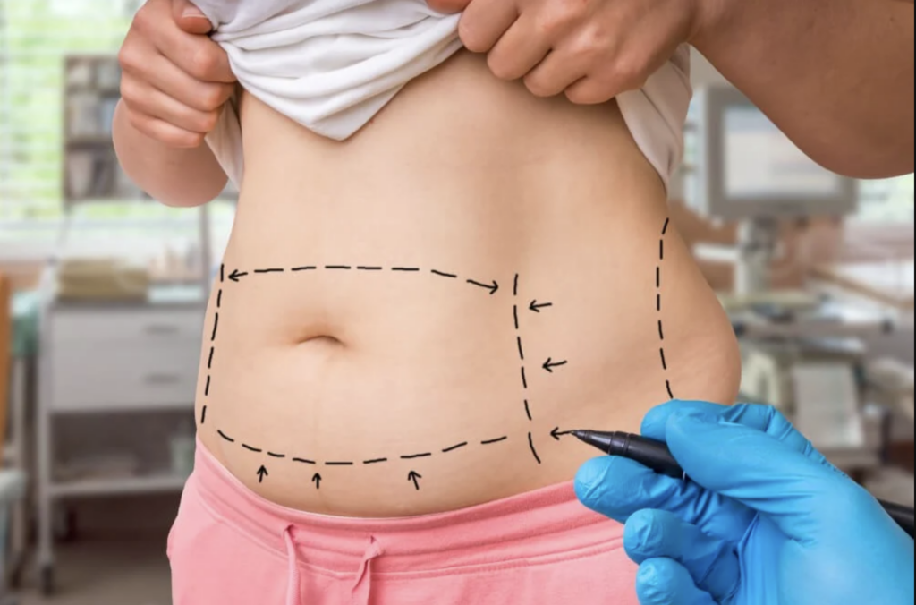 Patient holding up their shirt, revealing lines on the stomach indicating where the doctor will make incisions during surgery