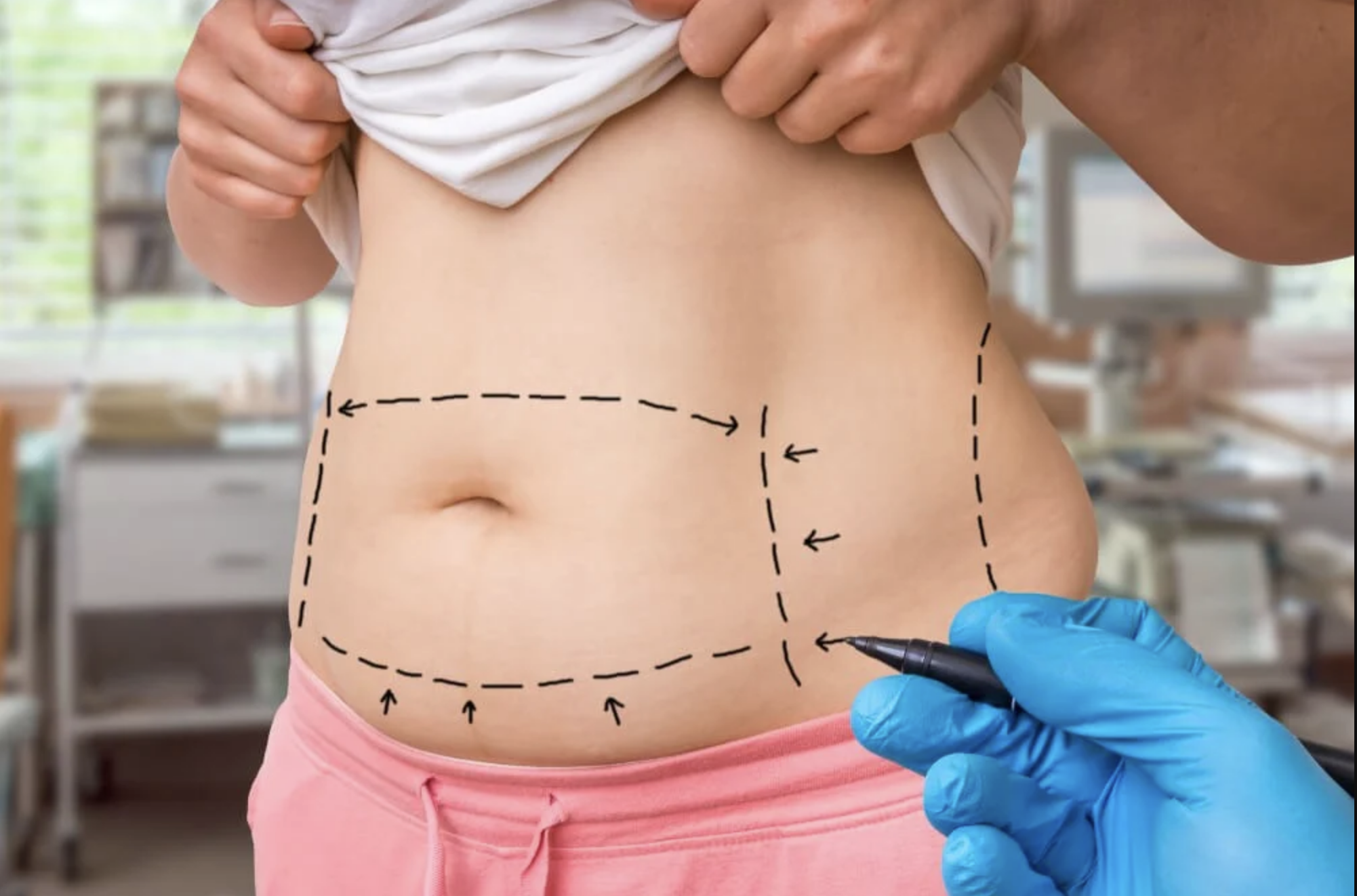 Patient holding up their shirt, revealing lines on the stomach indicating where the doctor will make incisions during surgery