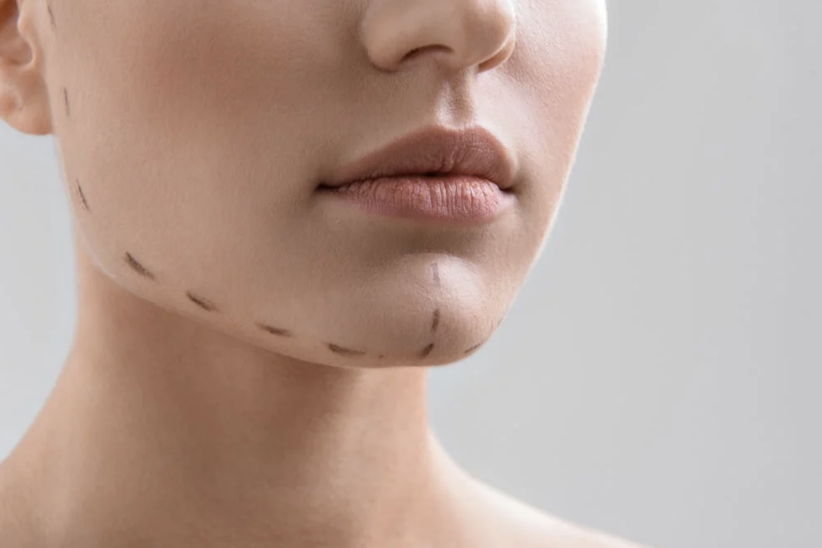 Patient with markings on her face, to indicate where the doctor will cut during surgery