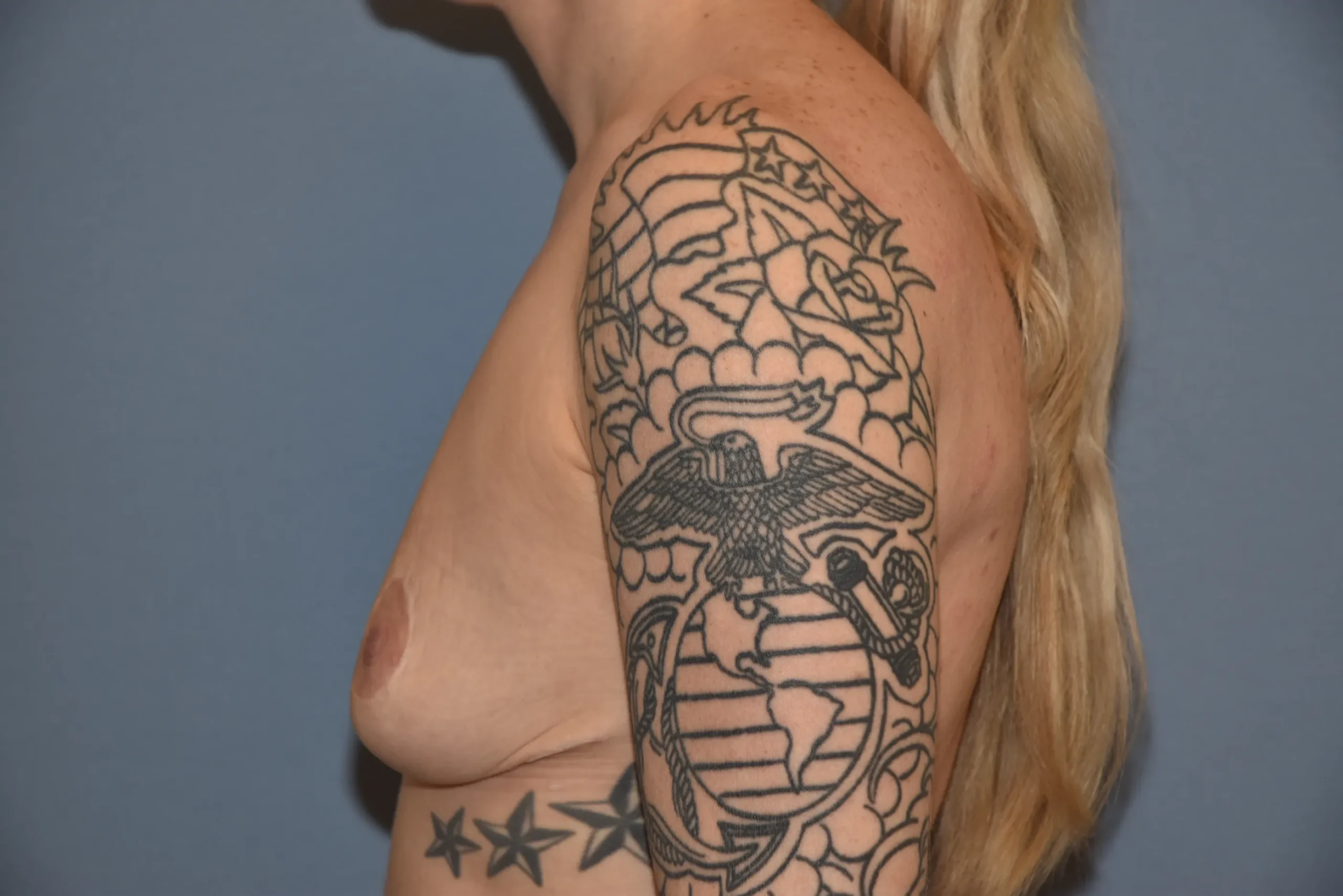 Before side view of breast augmentation patient 29803