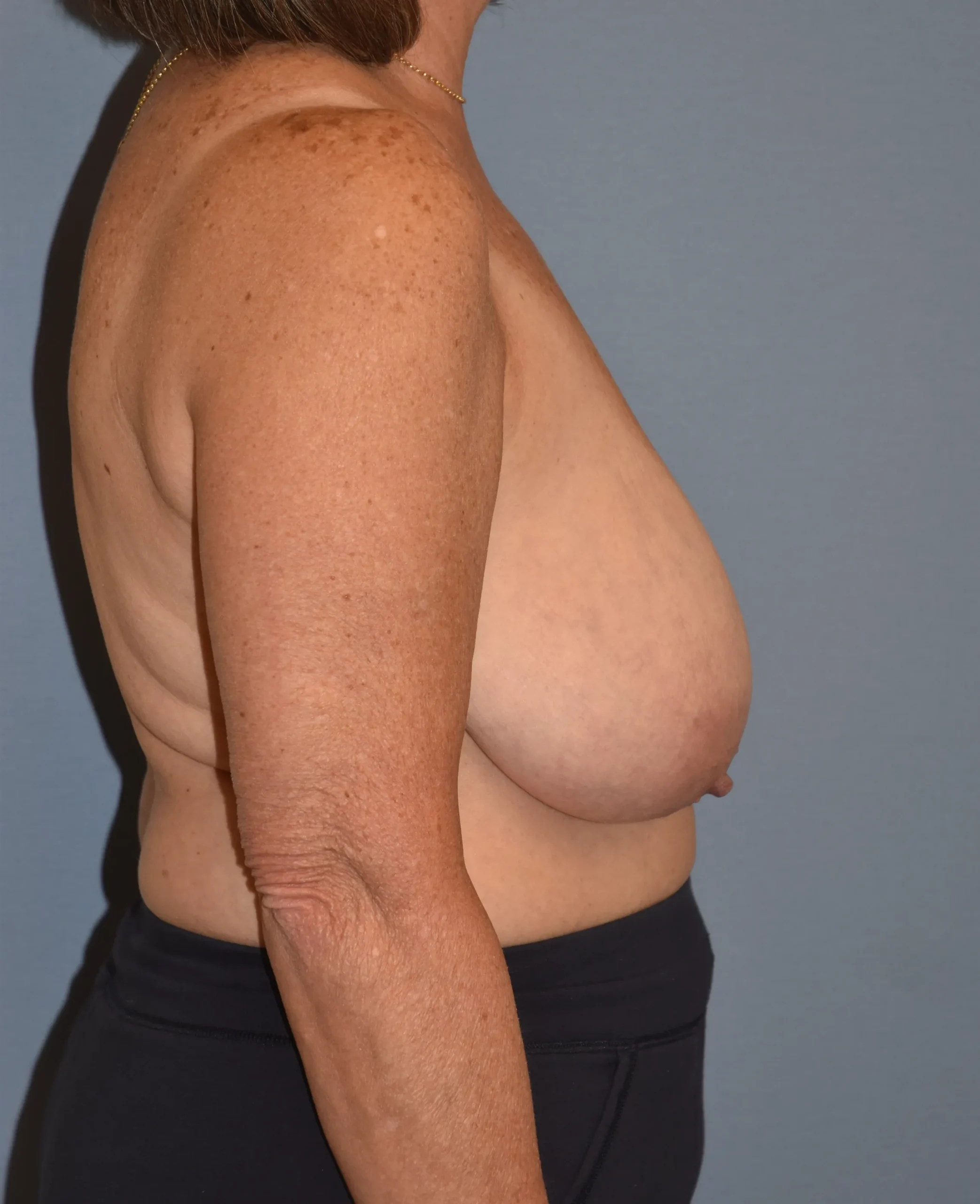 Before side view of breast reduction and fat grafting to shoulders for patient 35461