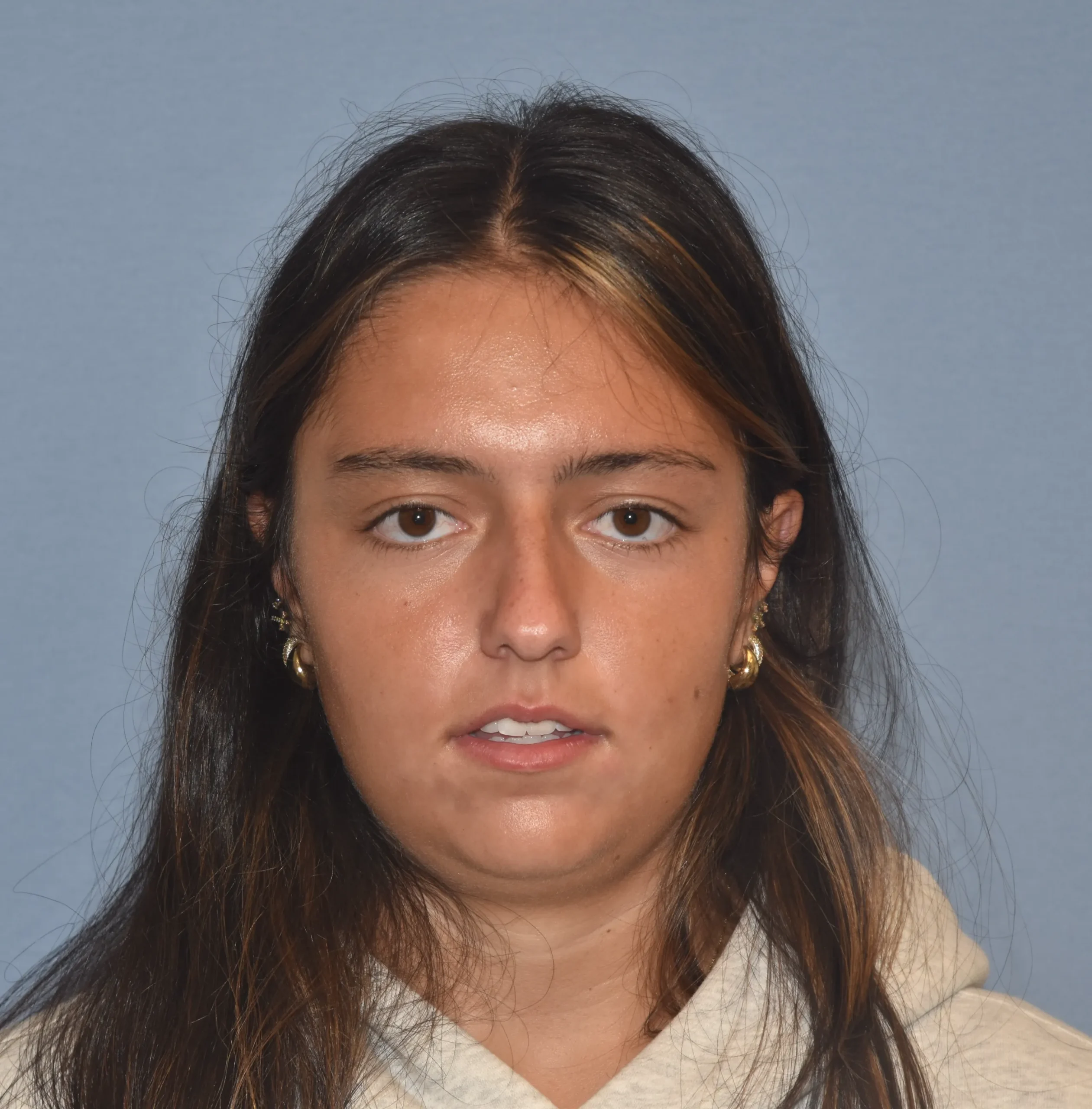 Before front-facing view of Rhinoplasty Patient 39989