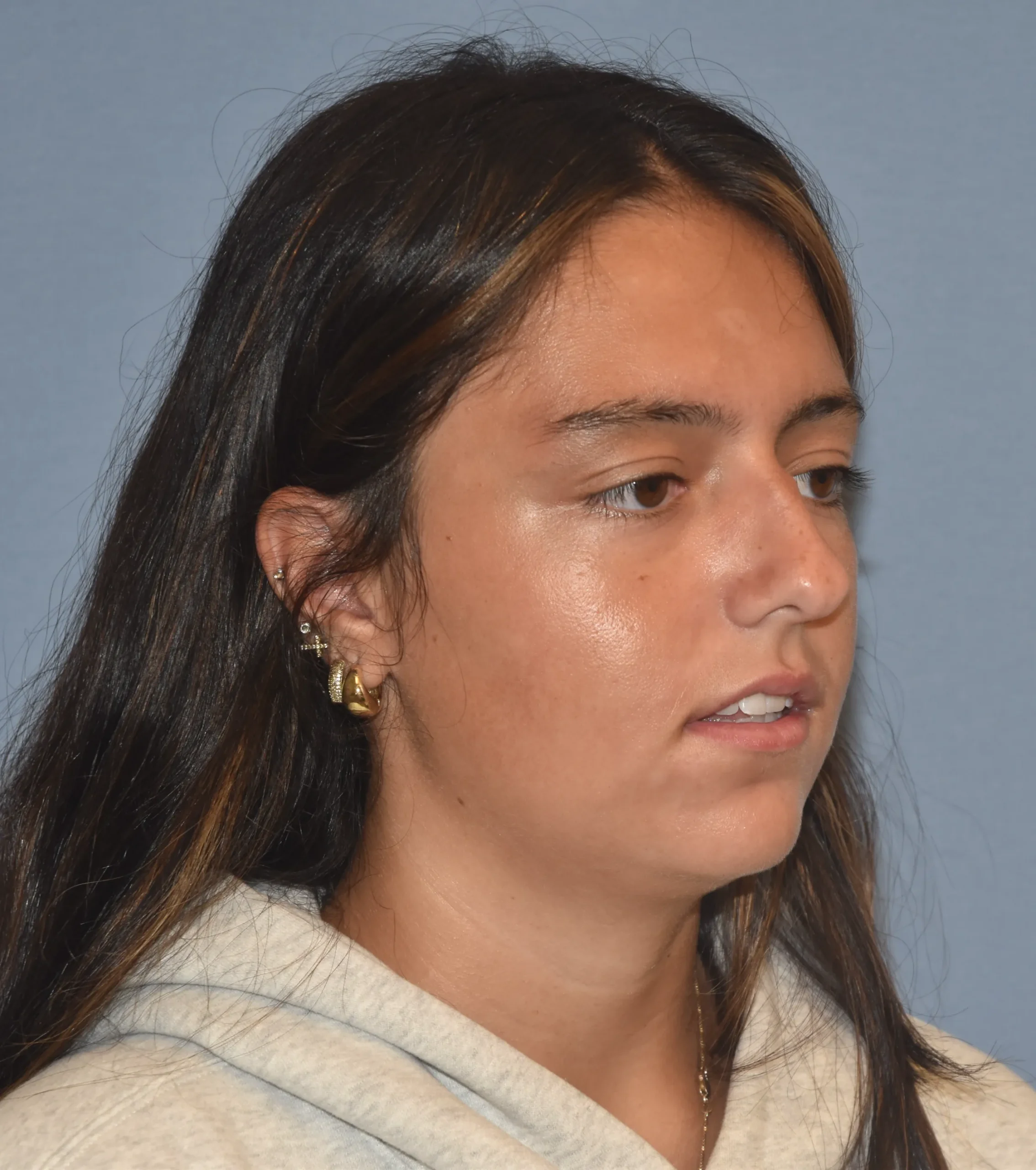 Before 45 degree view of Rhinoplasty Patient 39989