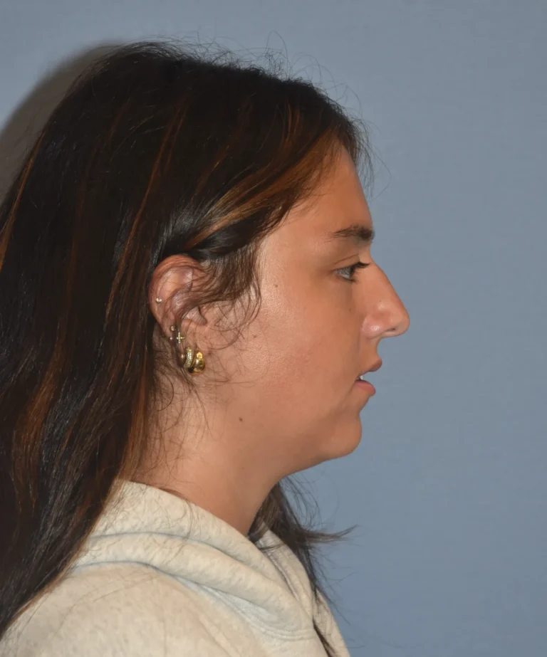 Before side-facing view of Rhinoplasty Patient 39989