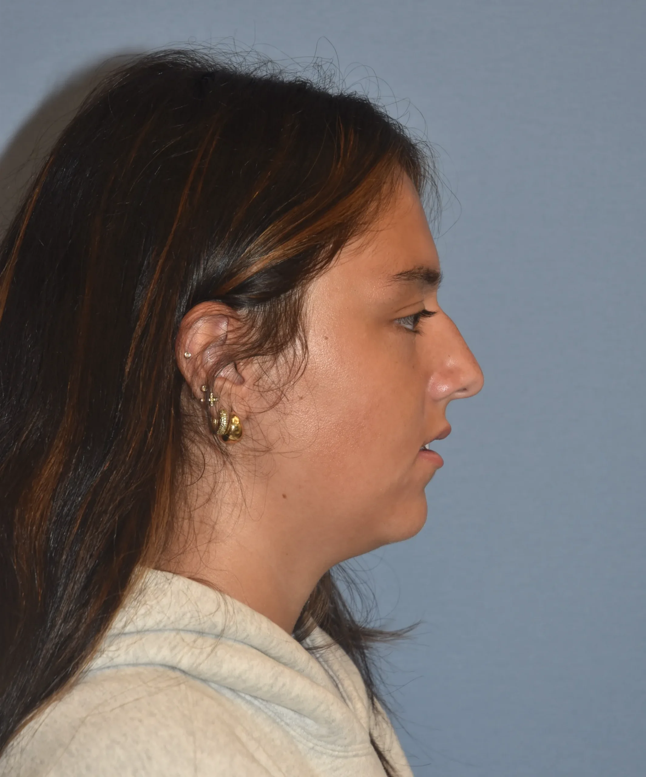 Before side-facing view of Rhinoplasty Patient 39989