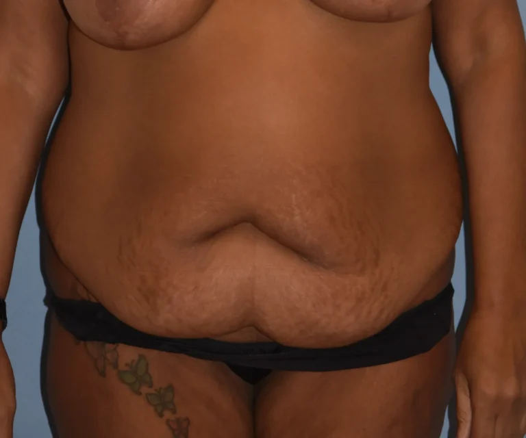 Before front-facing Tummy Tuck patient 37280