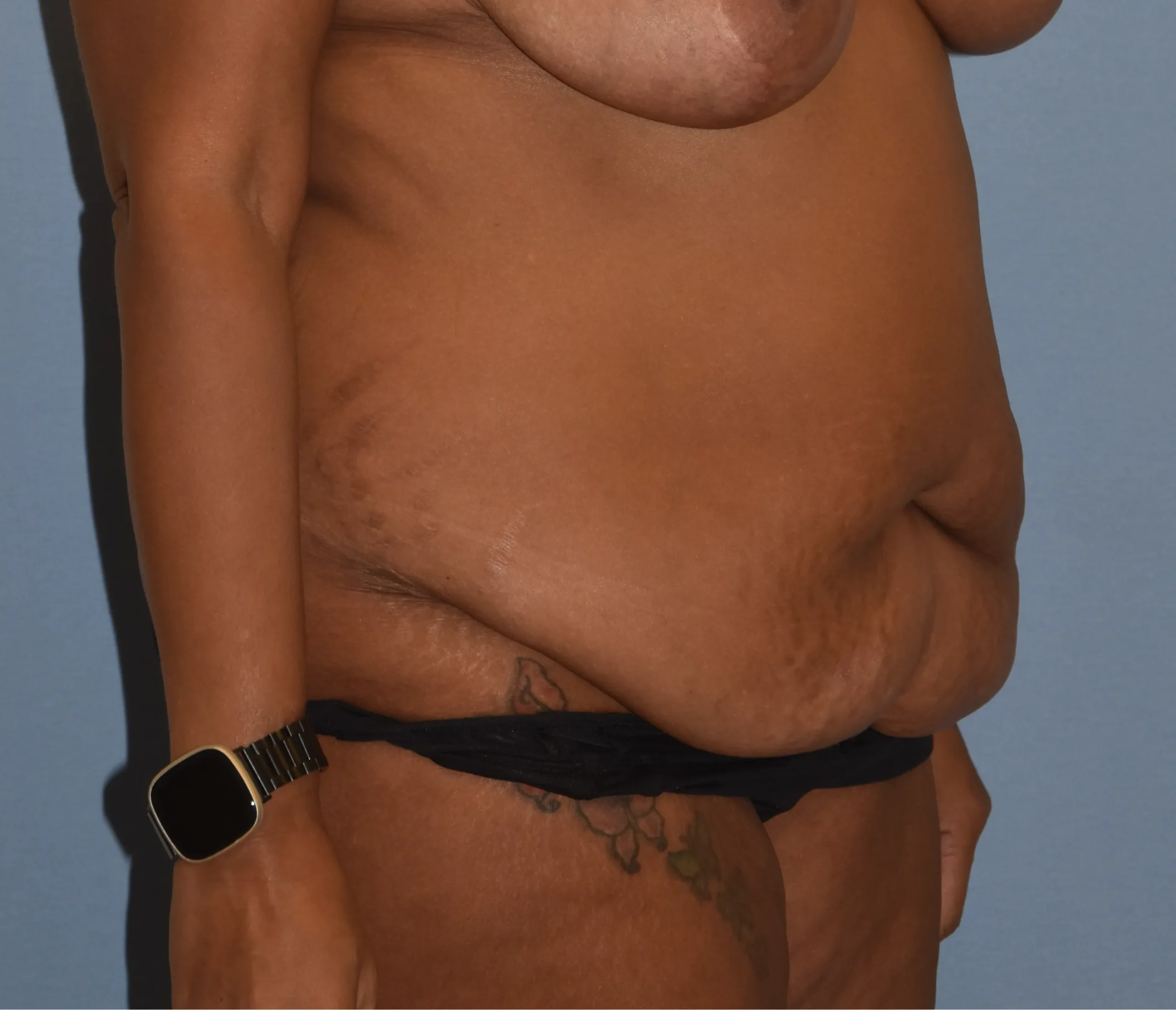 Before 45-degree view of Tummy Tuck patient 37280