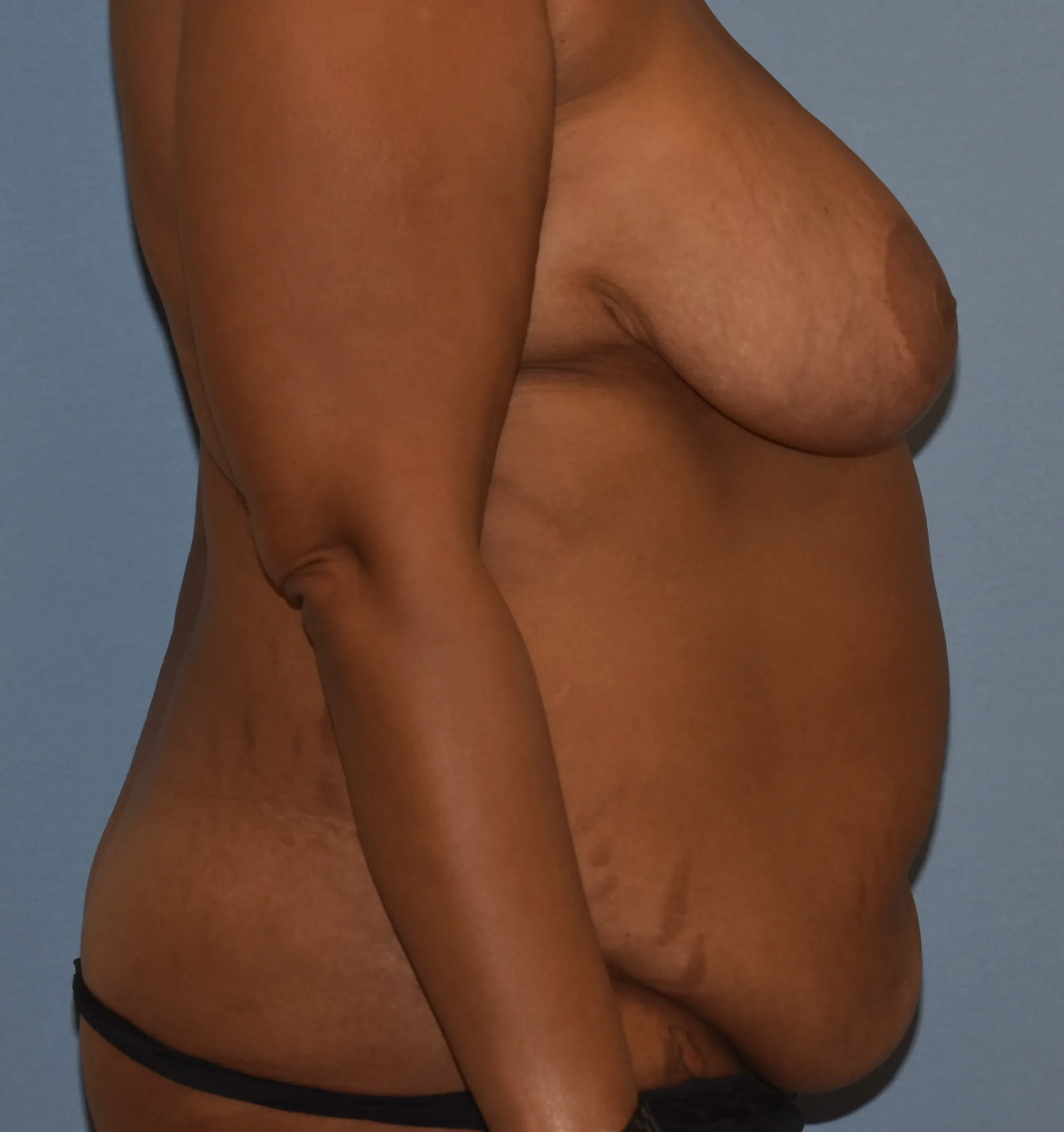 Before side view of Tummy Tuck patient 37280