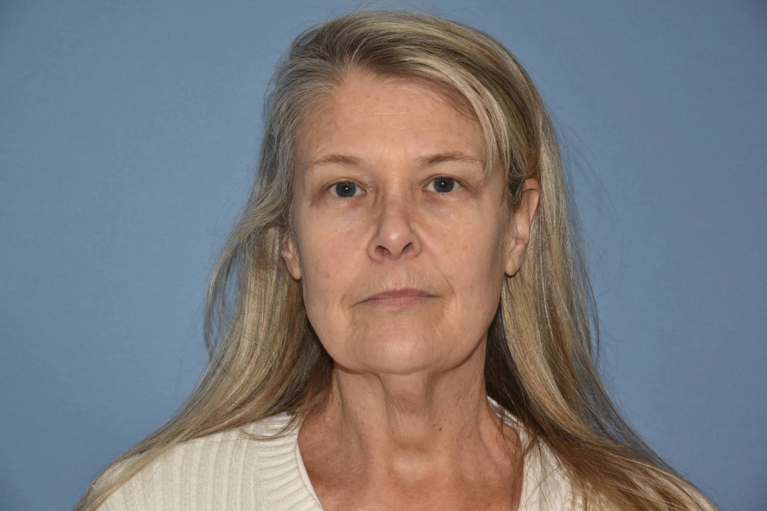 BEFORE Facelift and neck lift - front view not smiling
