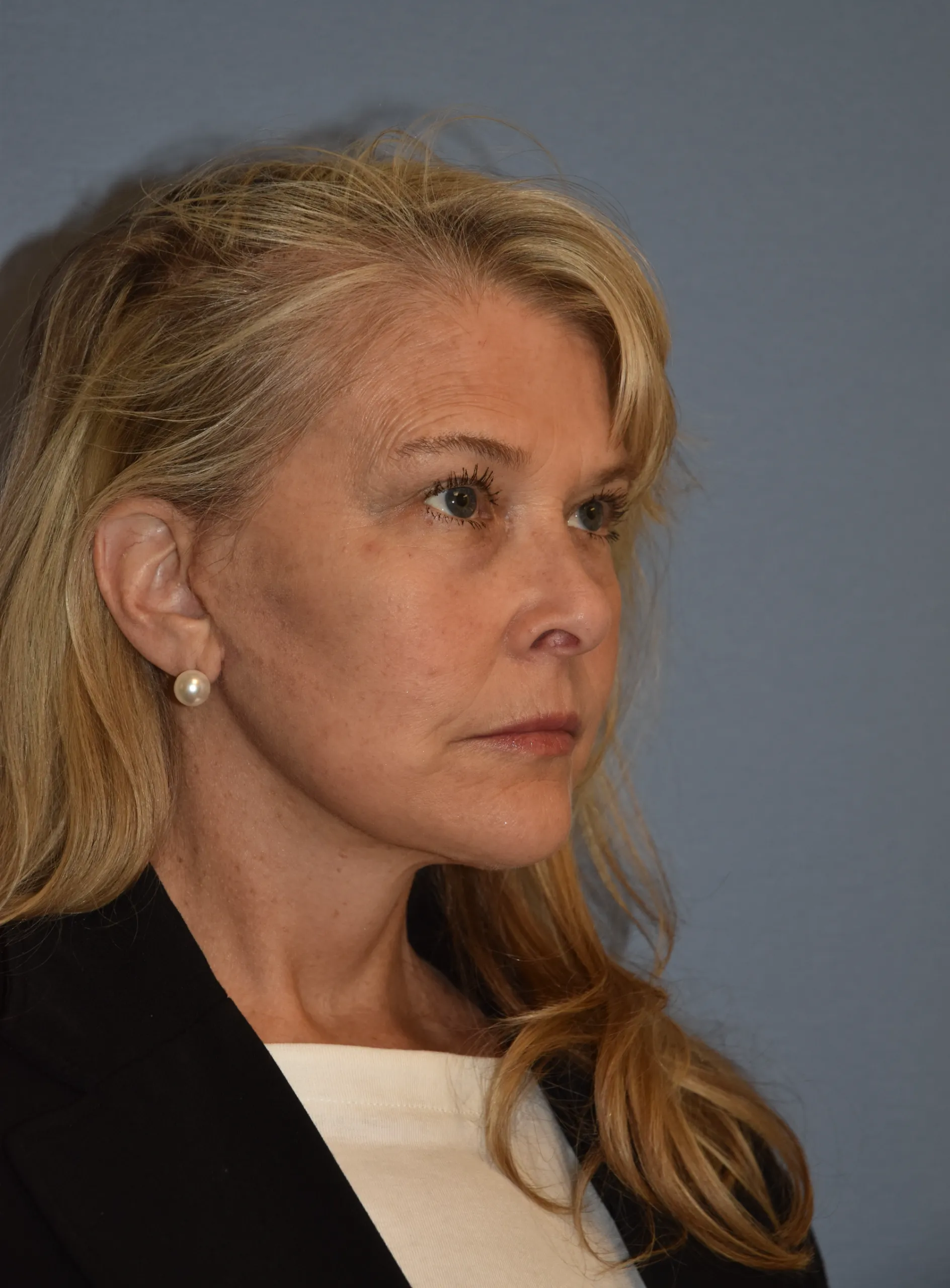 AFTER Facelift and neck lift - oblique view facing left