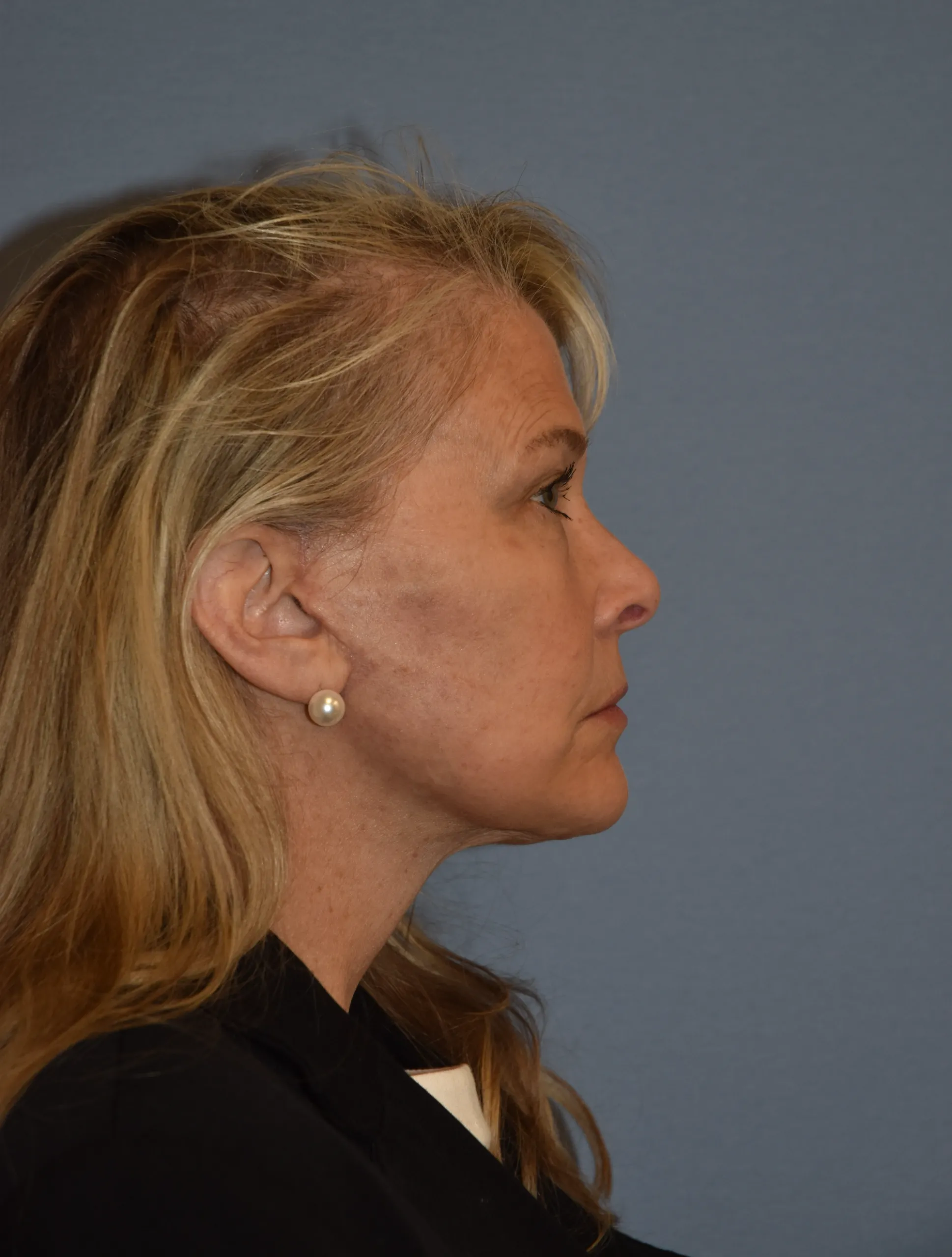 AFTER Facelift and neck lift - side view facing left - chin up