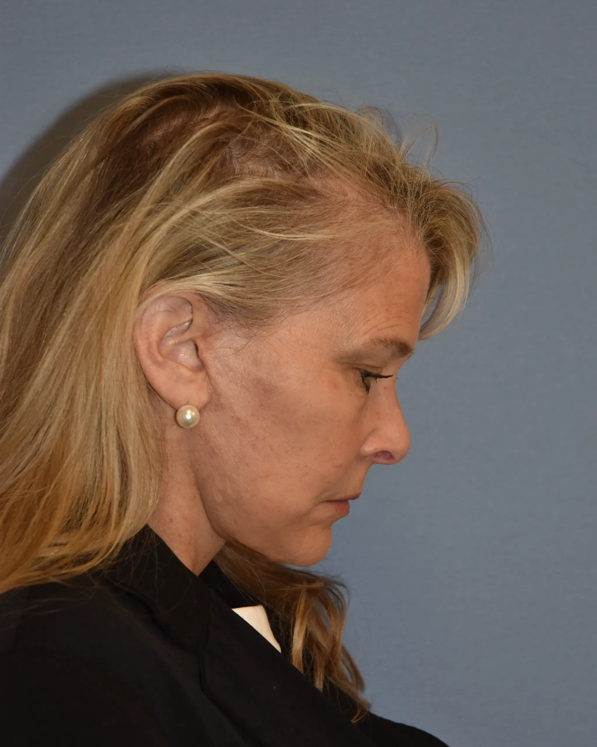 AFTER Facelift and neck lift - side view facing left - chin down