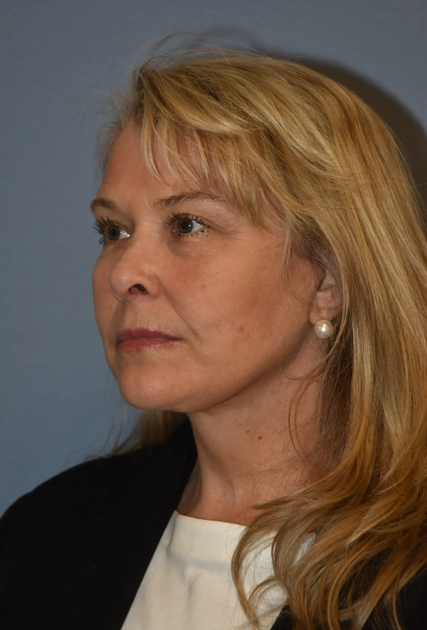 AFTER Facelift and neck lift - oblique view facing right