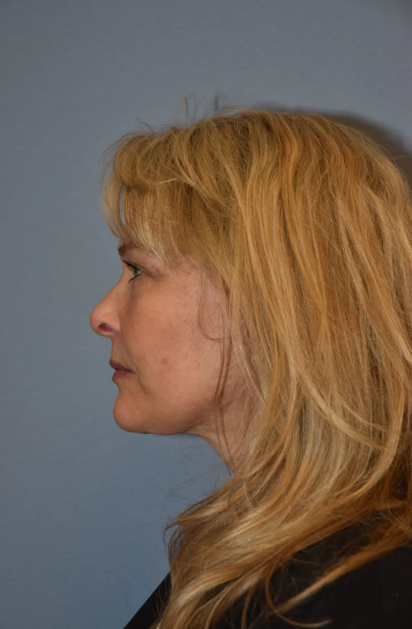 AFTER Facelift and neck lift - side view facing right
