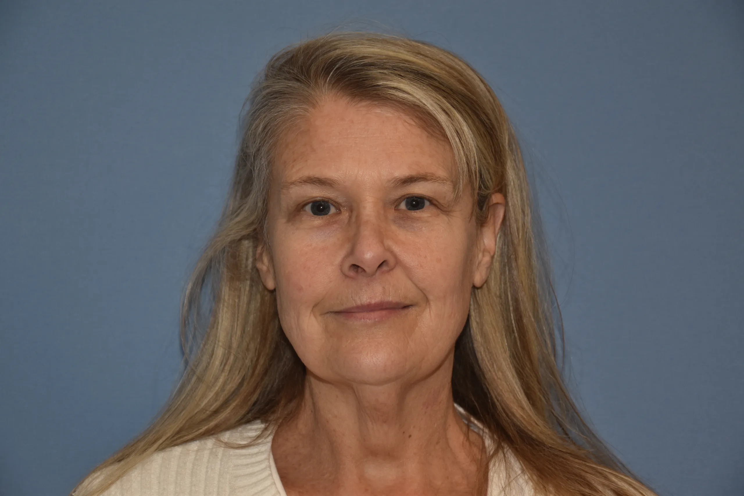 BEFORE Facelift and neck lift - front view smiling