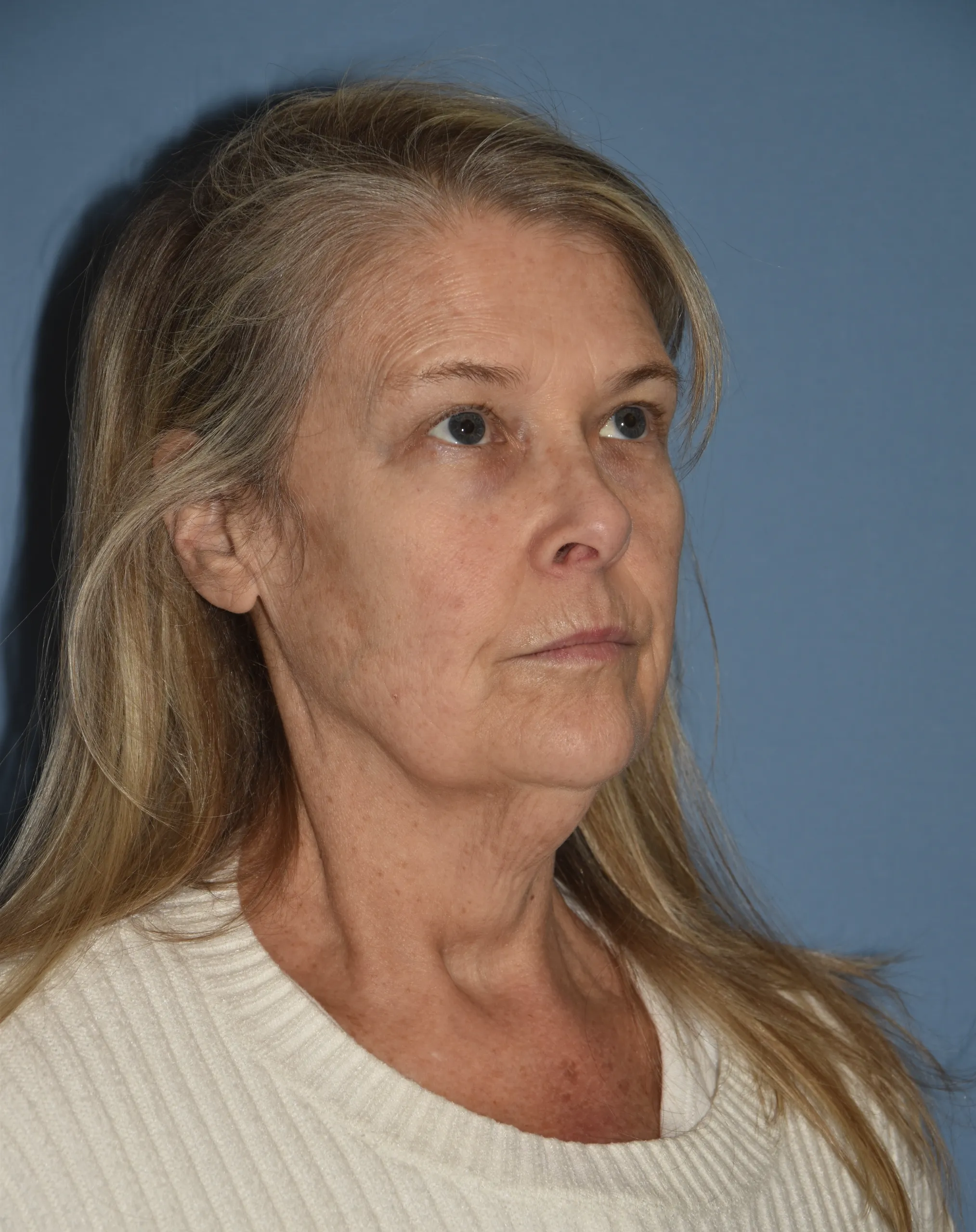 BEFORE Facelift and neck lift - oblique view facing left