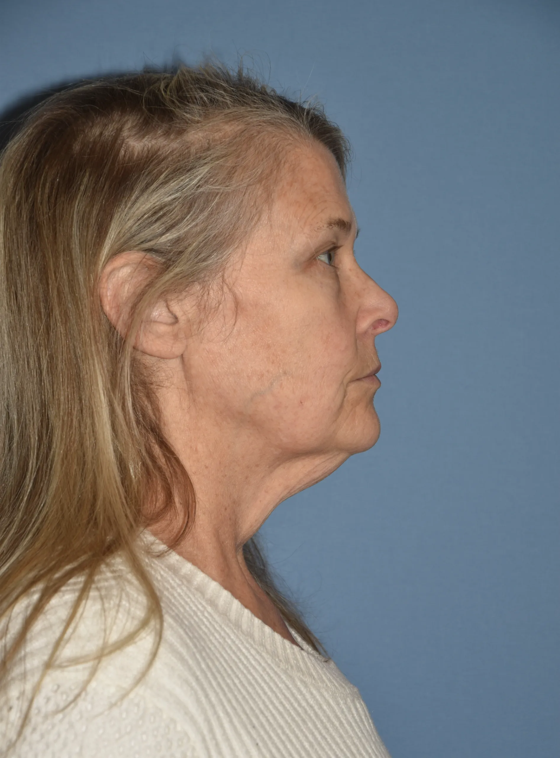 BEFORE Facelift and neck lift - side view facing left - chin up