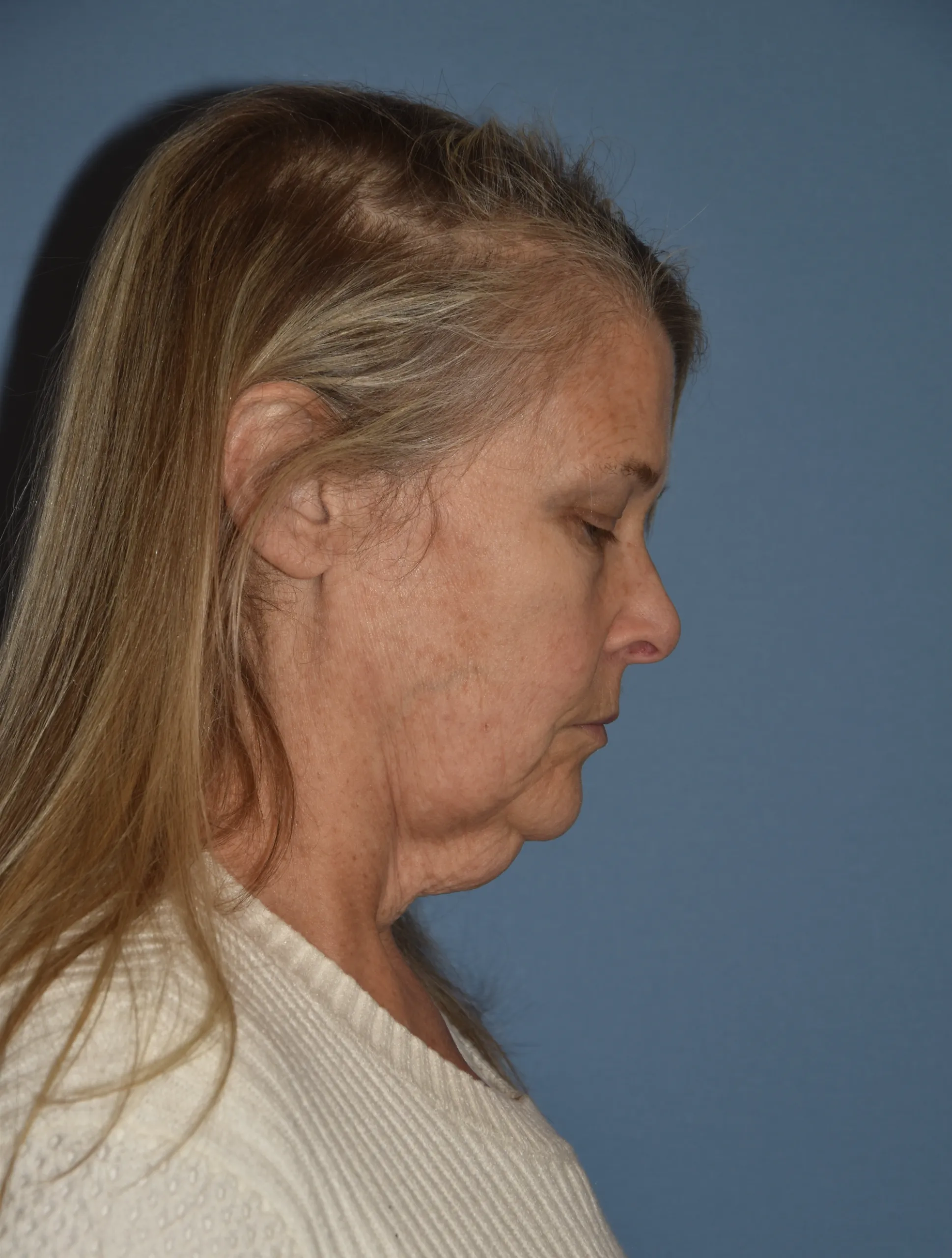 BEFORE Facelift and neck lift - side view facing left - chin down