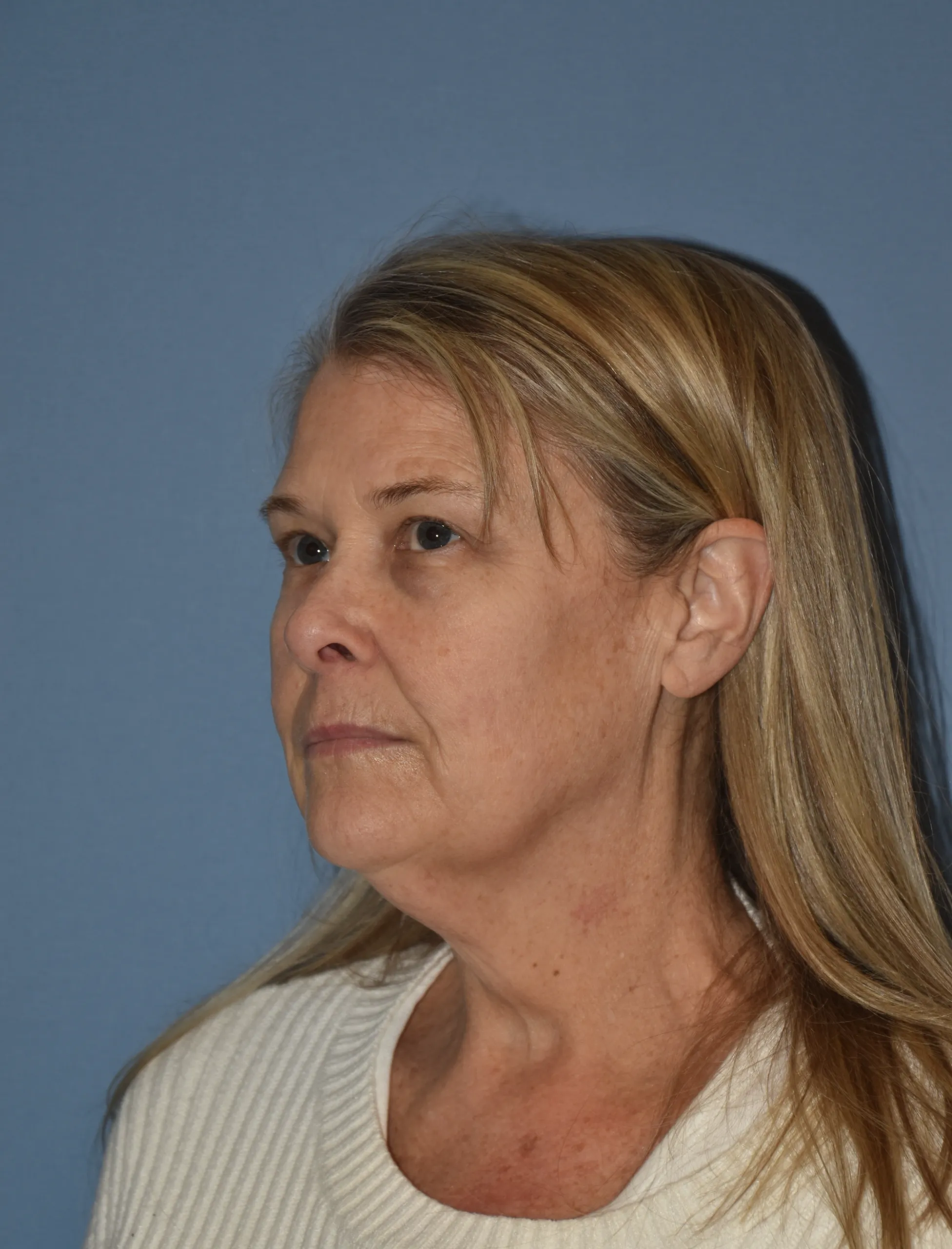 BEFORE Facelift and neck lift - oblique view facing right