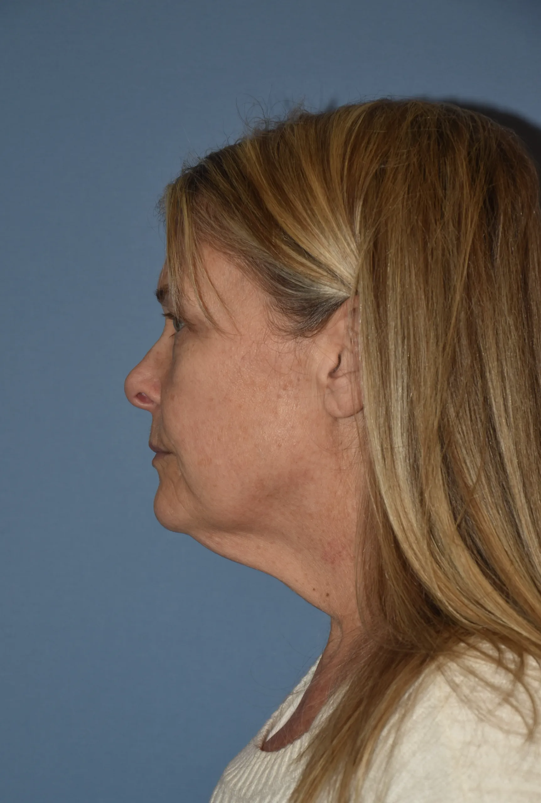 BEFORE Facelift and neck lift - side view facing right
