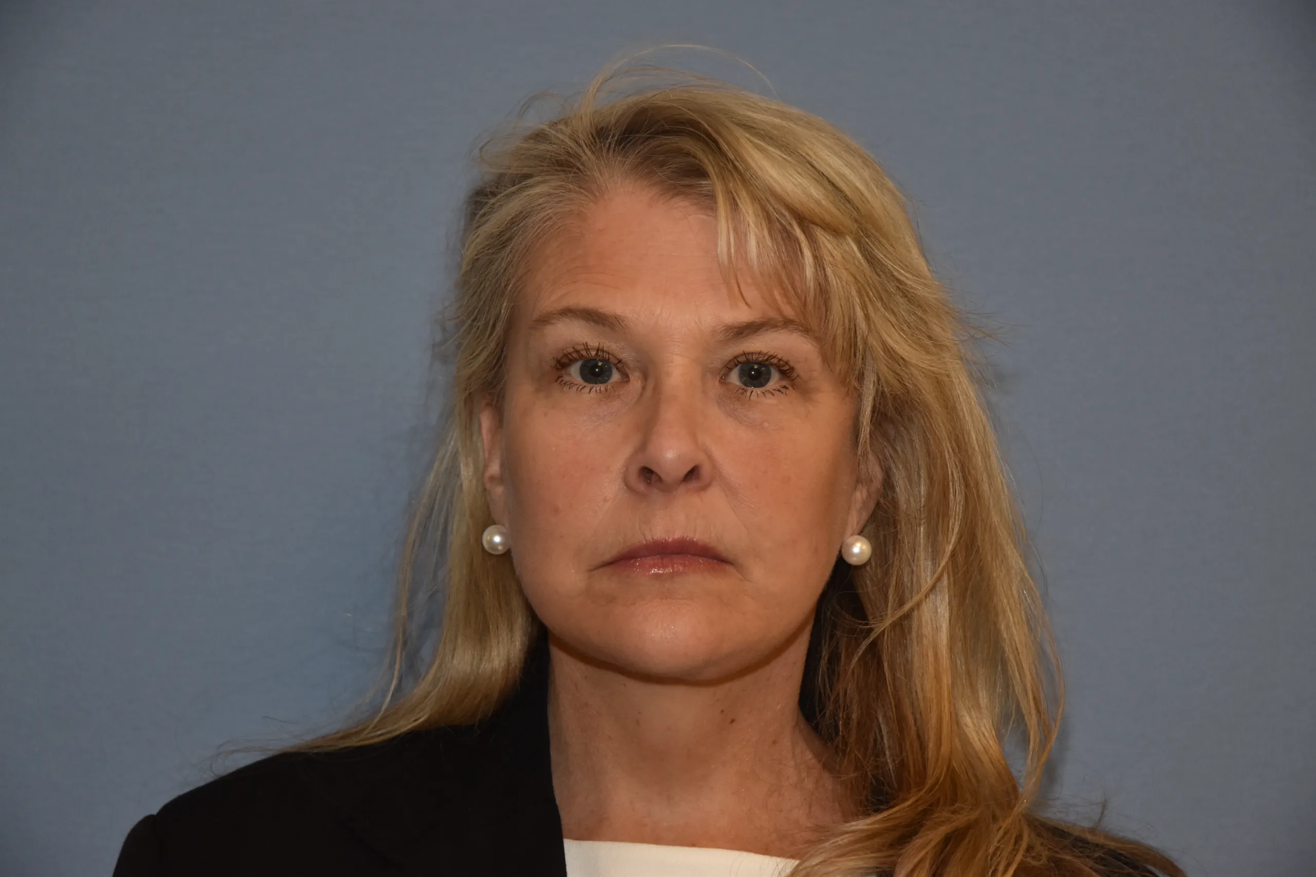 AFTER Facelift and neck lift - front view not smiling