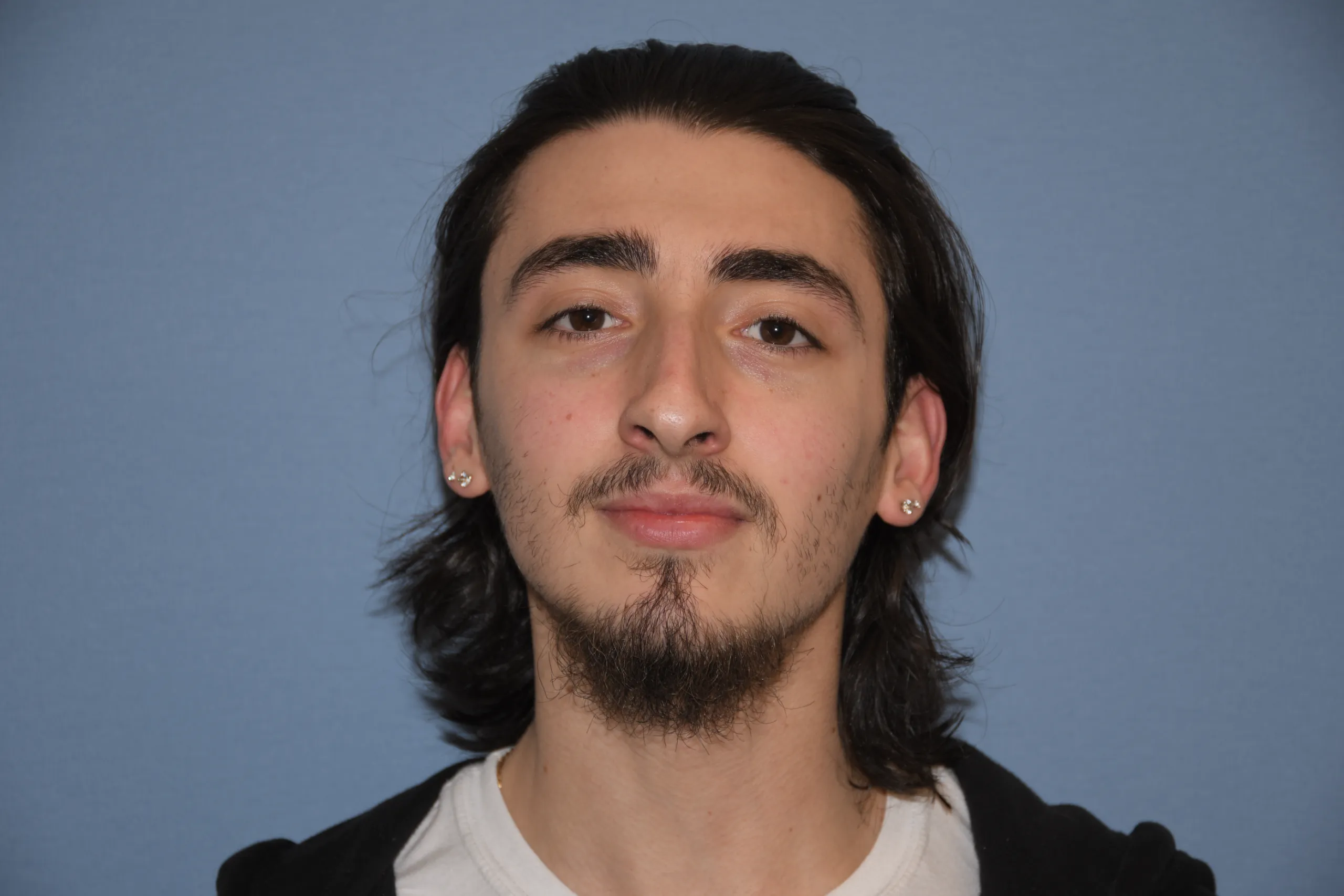 BEFORE Rhinoplasty and Septoplasty - front view