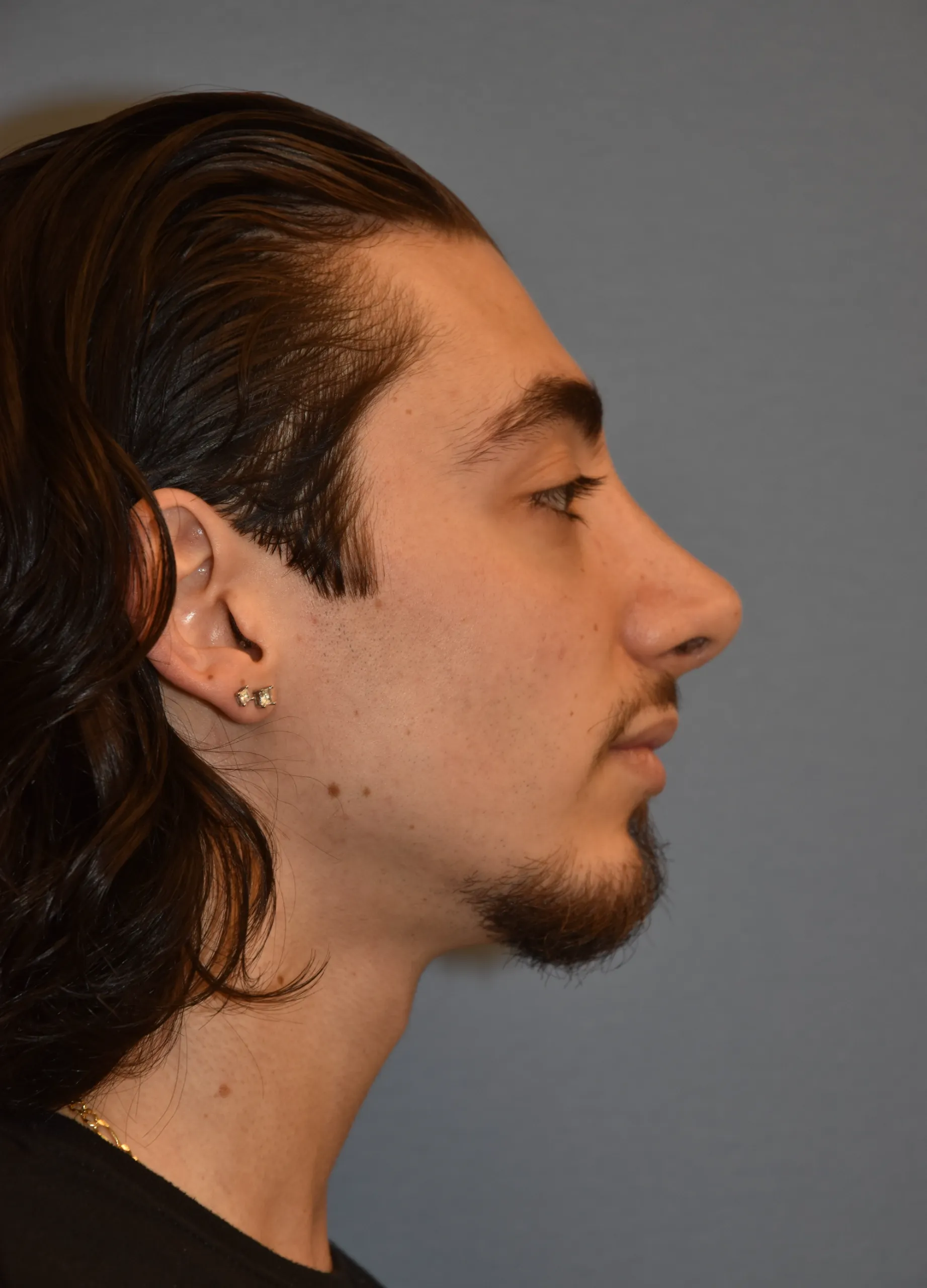 AFTER Rhinoplasty and Septoplasty - side view facing left