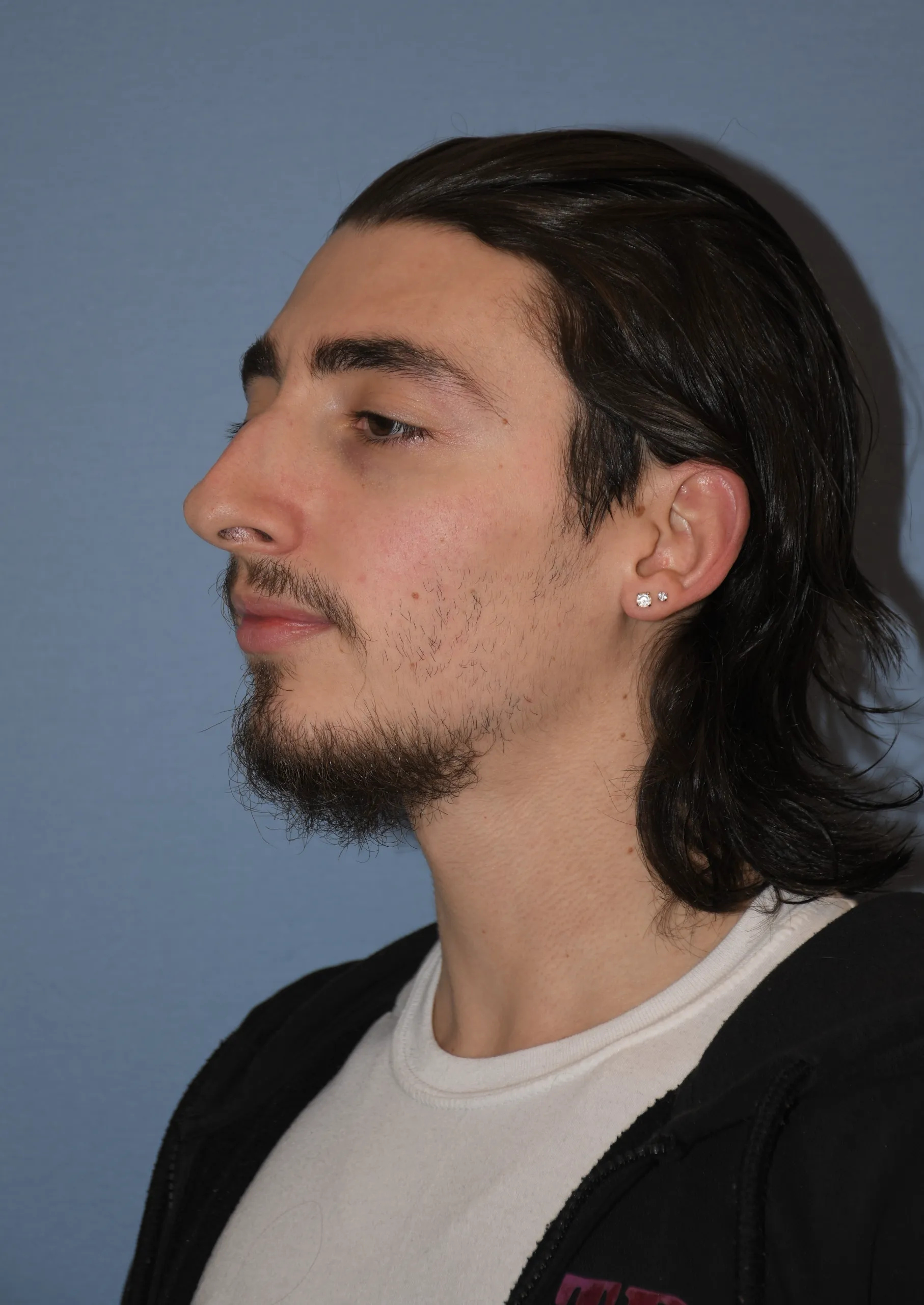 BEFORE Rhinoplasty and Septoplasty - oblique view facing right