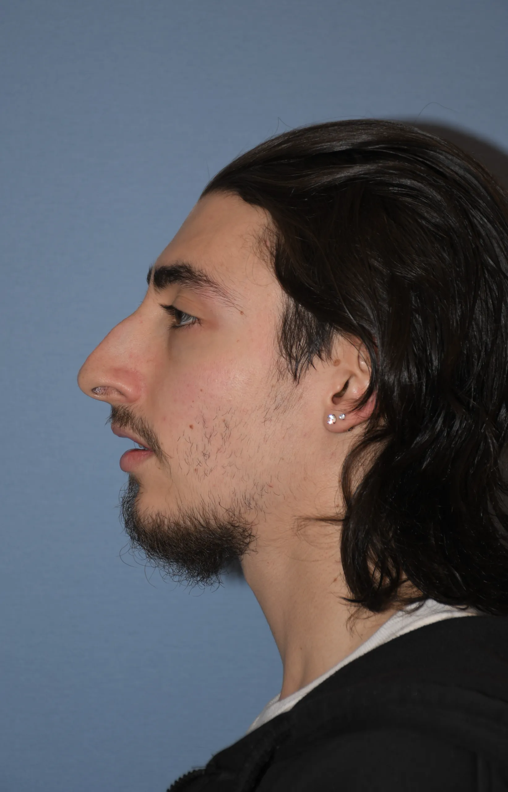 BEFORE Rhinoplasty and Septoplasty - side view facing right
