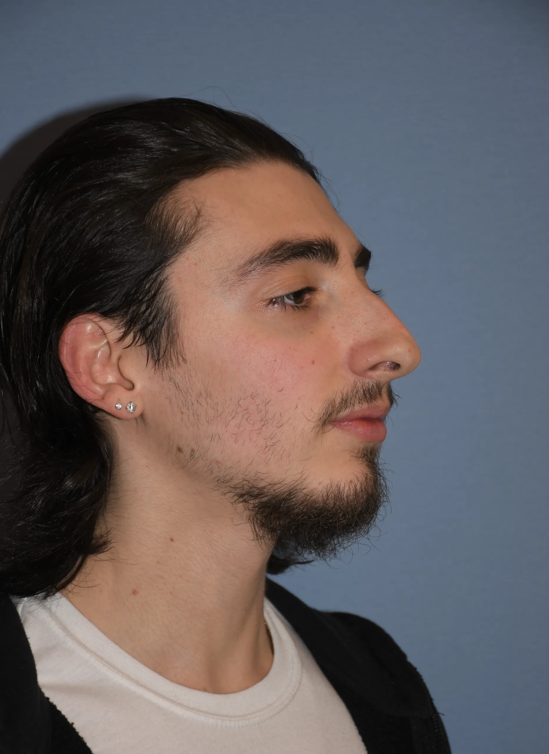 BEFORE Rhinoplasty and Septoplasty - oblique view facing left