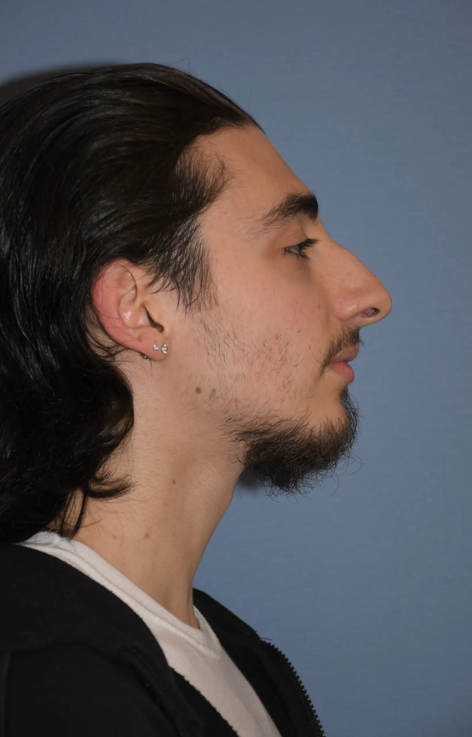 BEFORE Rhinoplasty and Septoplasty - side view facing left