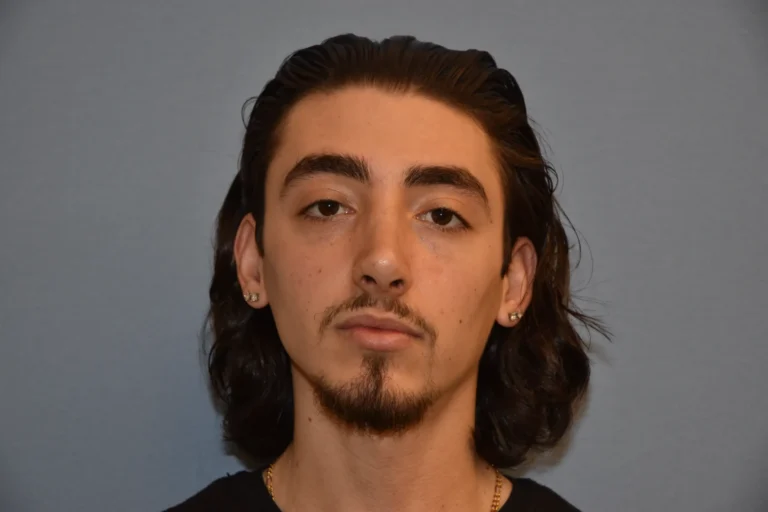 AFTER Rhinoplasty and Septoplasty - front view