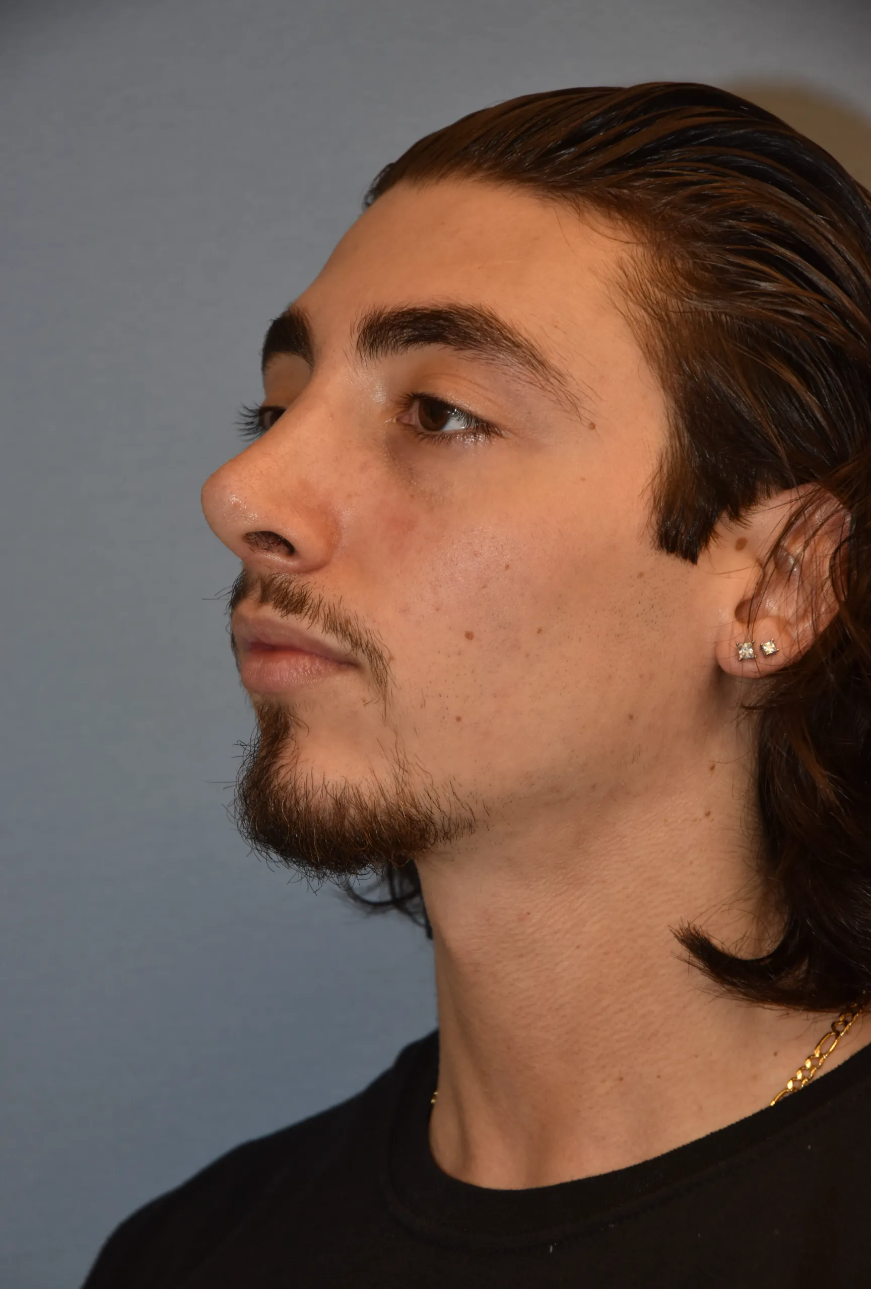 AFTER Rhinoplasty and Septoplasty - oblique view facing right
