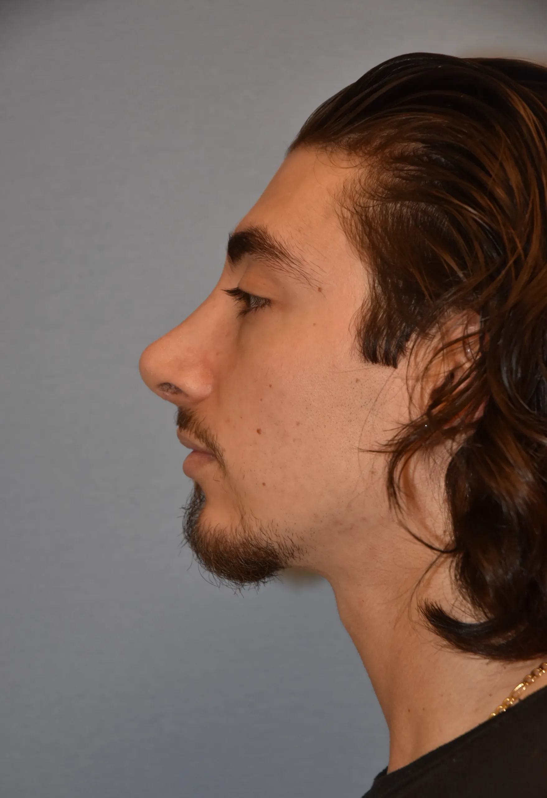 AFTER Rhinoplasty and Septoplasty - side view facing right