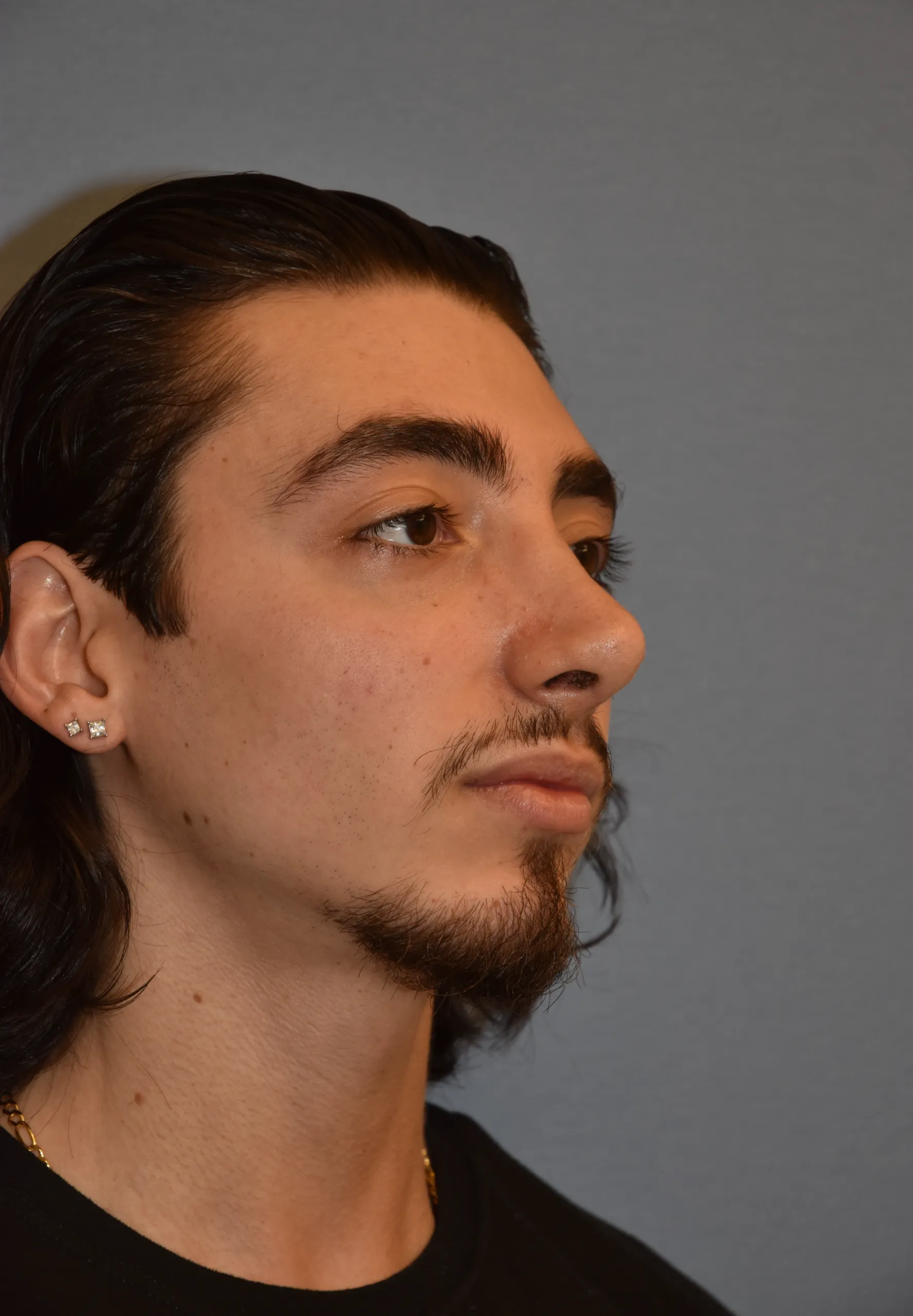 AFTER Rhinoplasty and Septoplasty - oblique view facing left