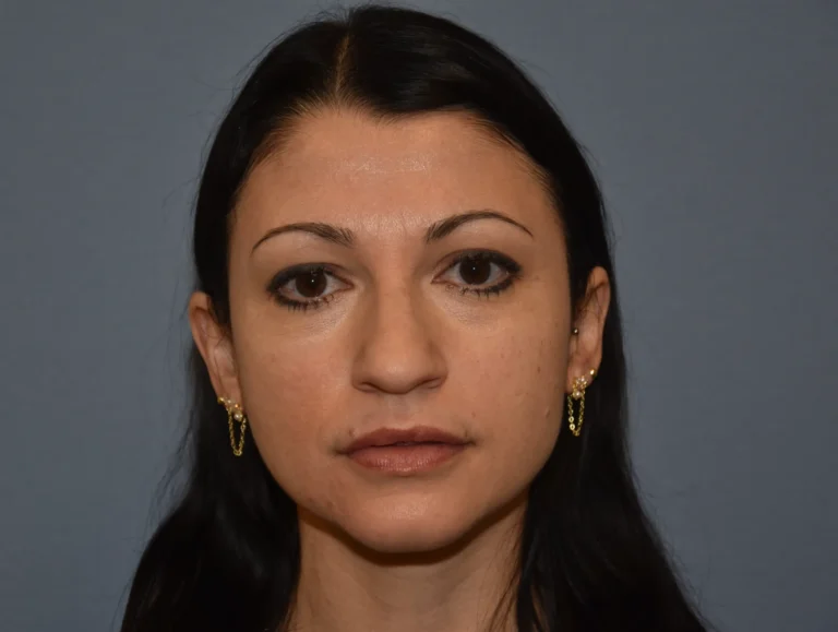 BEFORE Rhinoplasty - front view