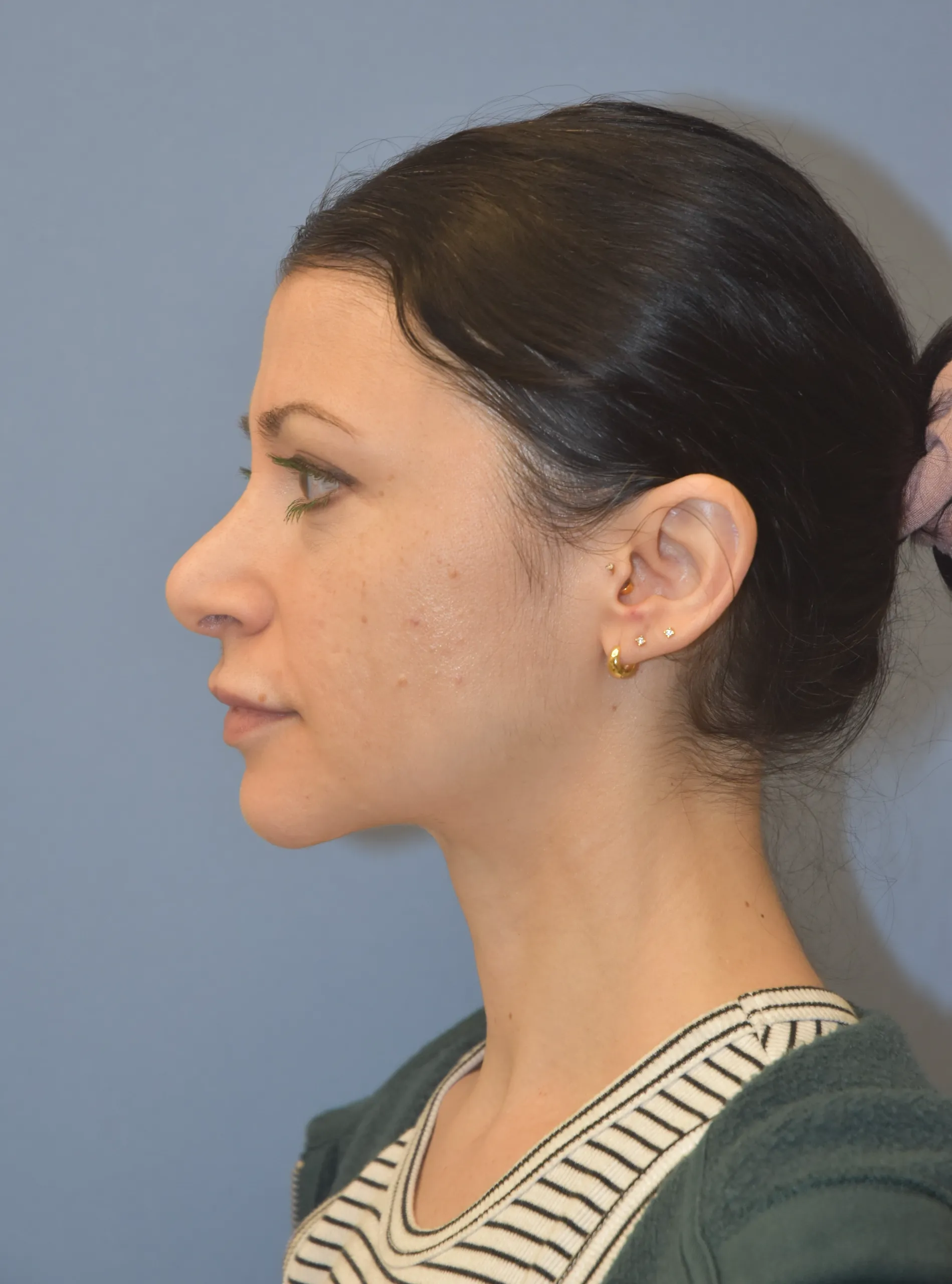 AFTER Rhinoplasty - side view looking right