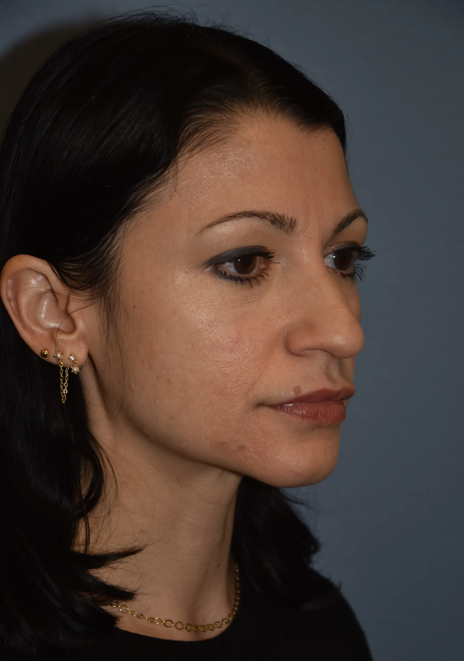 BEFORE Rhinoplasty - oblique view looking left