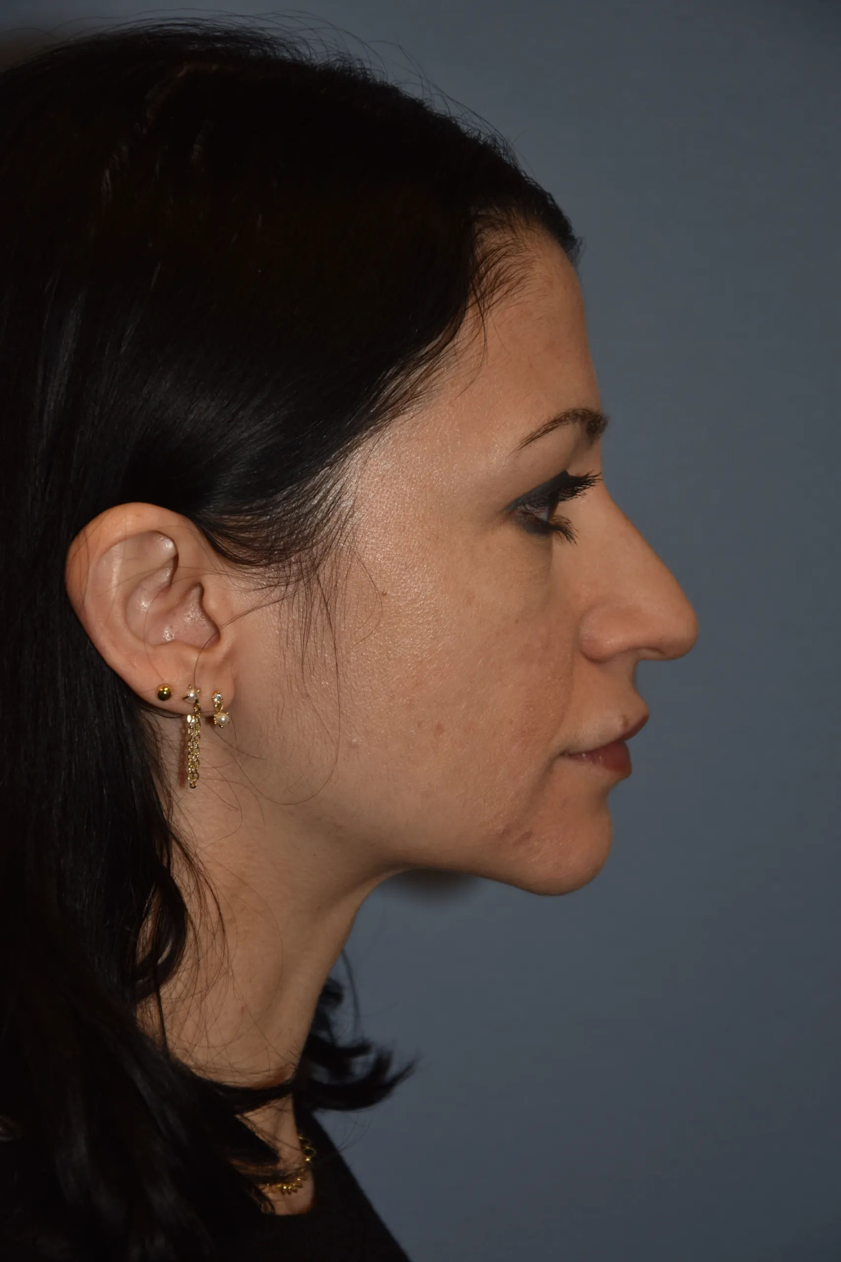 BEFORE Rhinoplasty - side view looking left