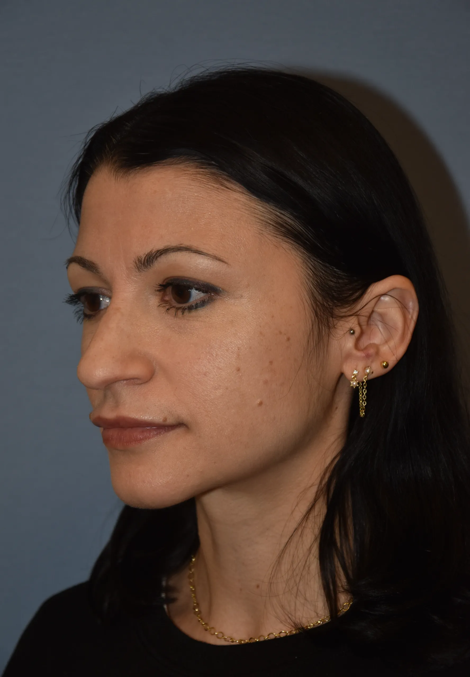 BEFORE Rhinoplasty - oblique view looking right