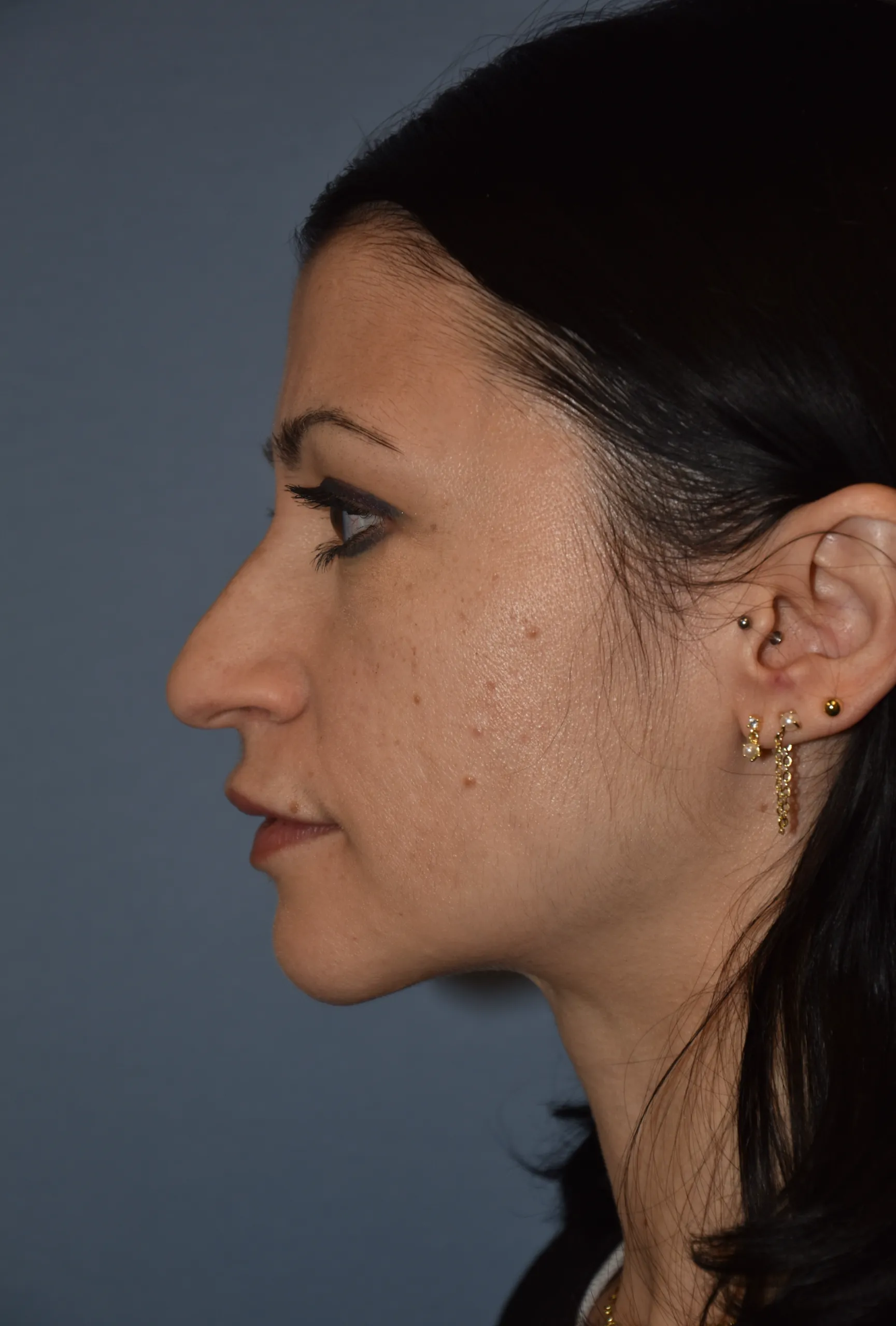 BEFORE Rhinoplasty - side view looking right