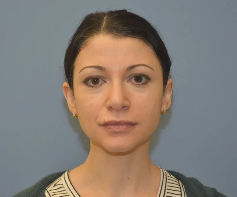 AFTER Rhinoplasty - front view