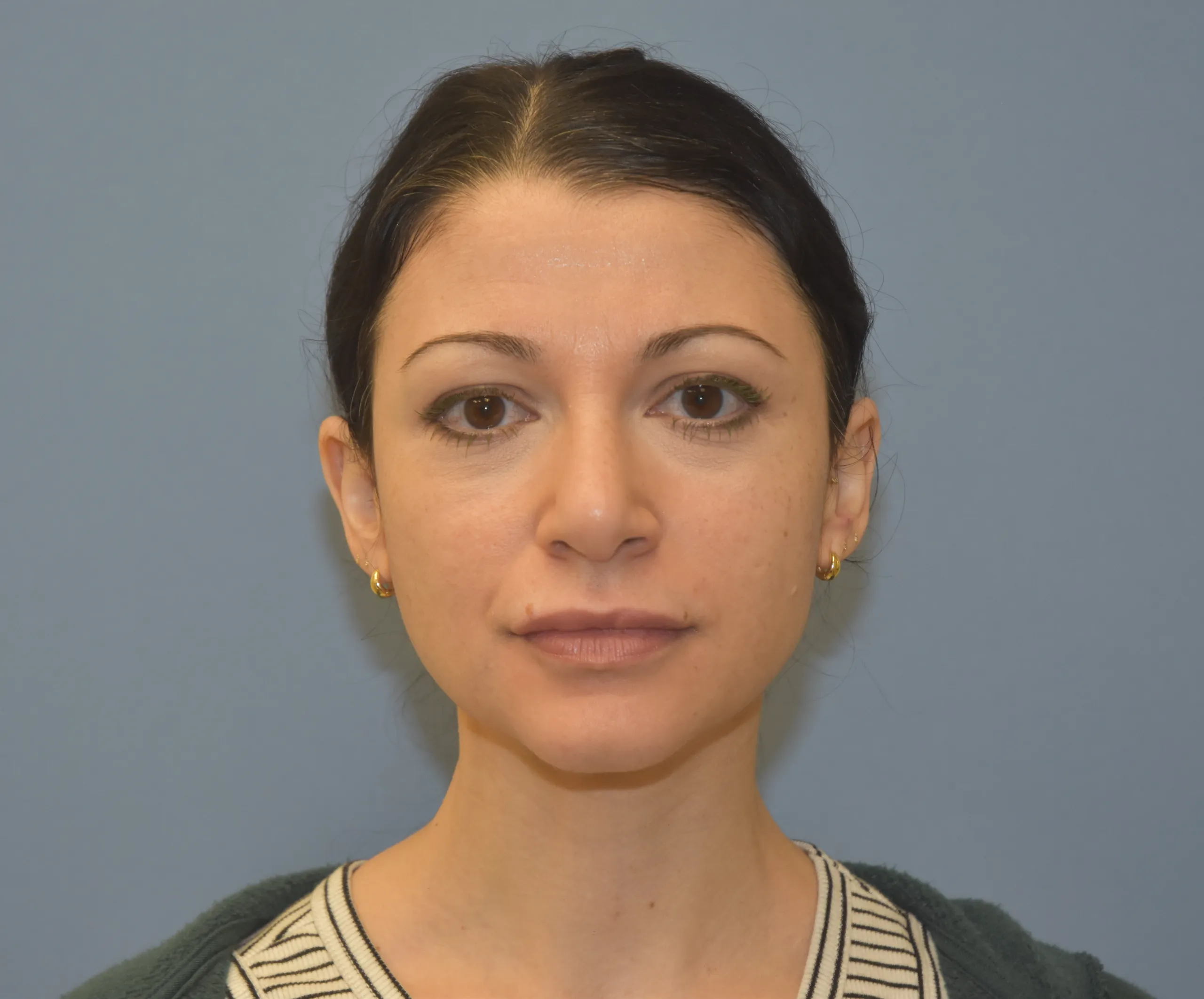 AFTER Rhinoplasty - front view