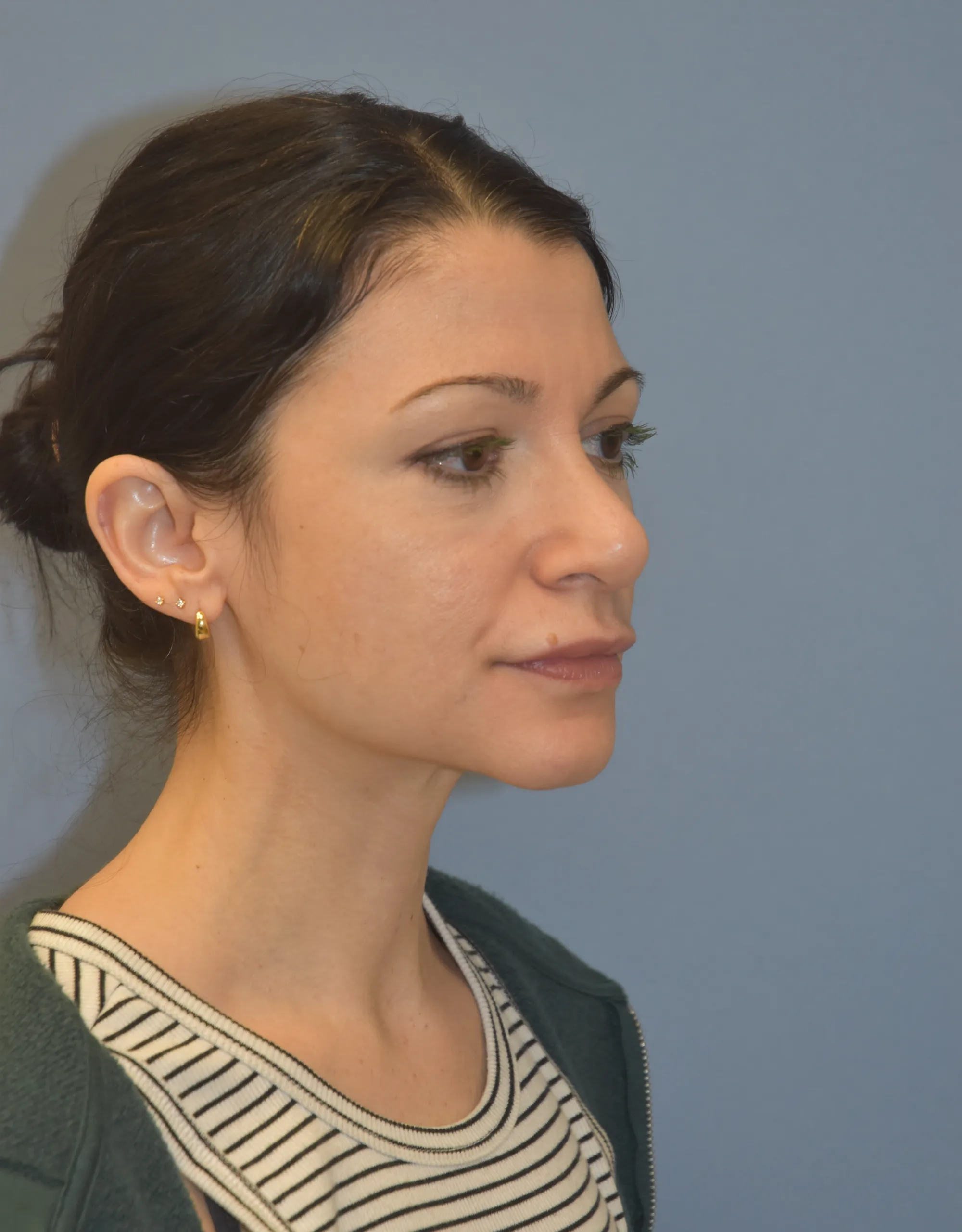 AFTER Rhinoplasty - oblique view looking left