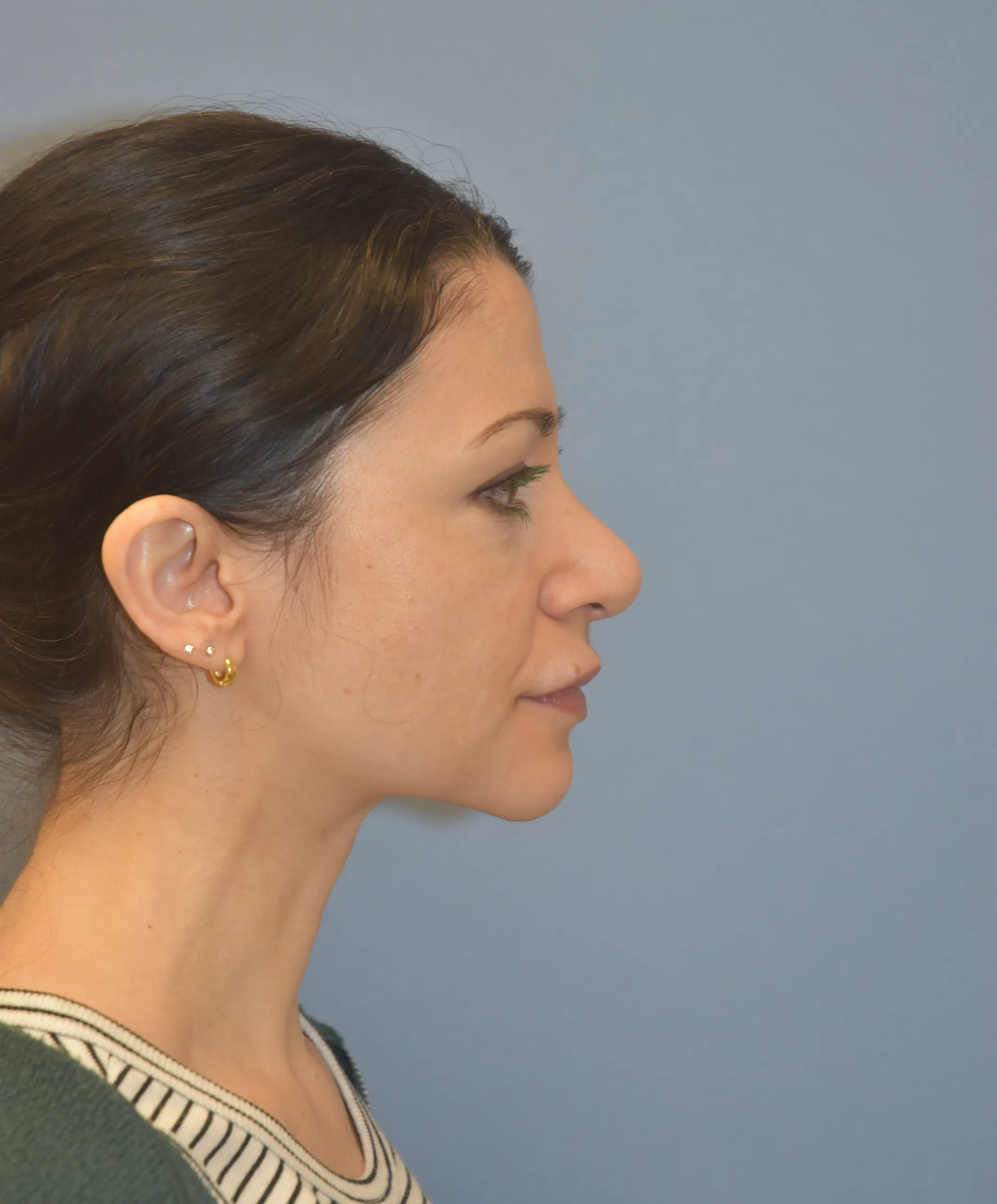 AFTER Rhinoplasty - side view looking left