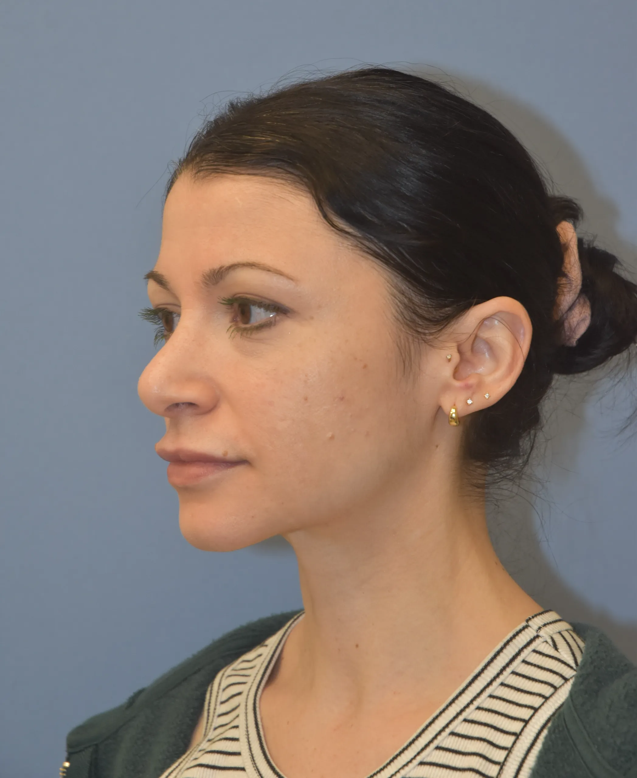 AFTER Rhinoplasty - oblique view looking right