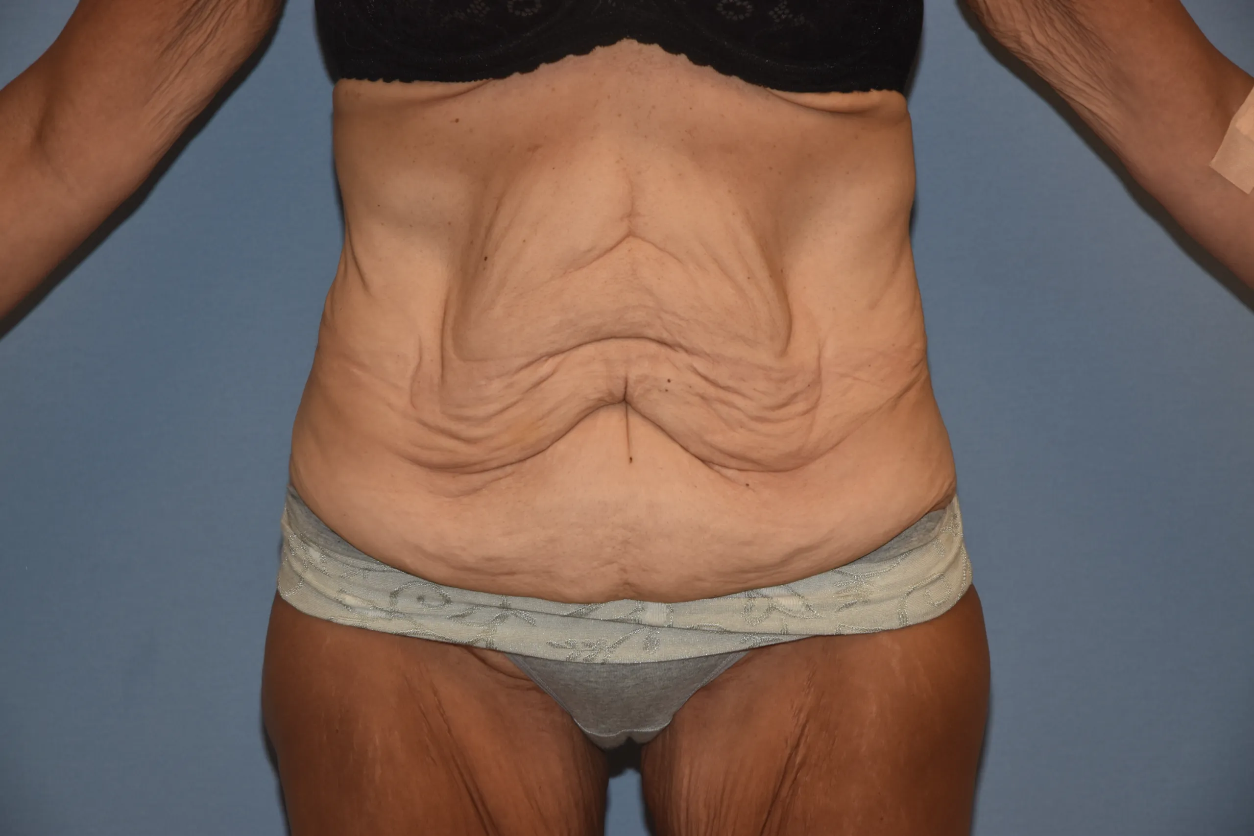 Before Fleur de Lis Tummy Tuck - front view