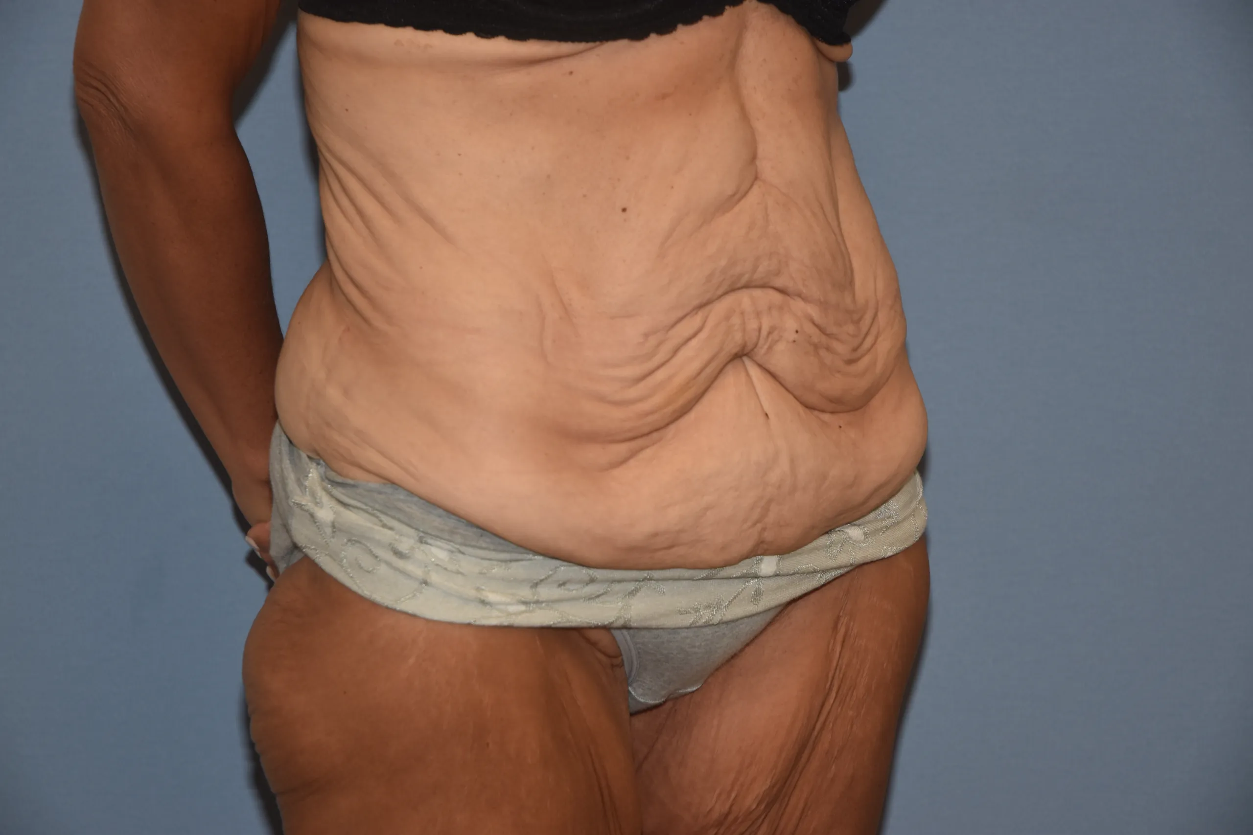 Before Fleur de Lis Tummy Tuck - oblique view