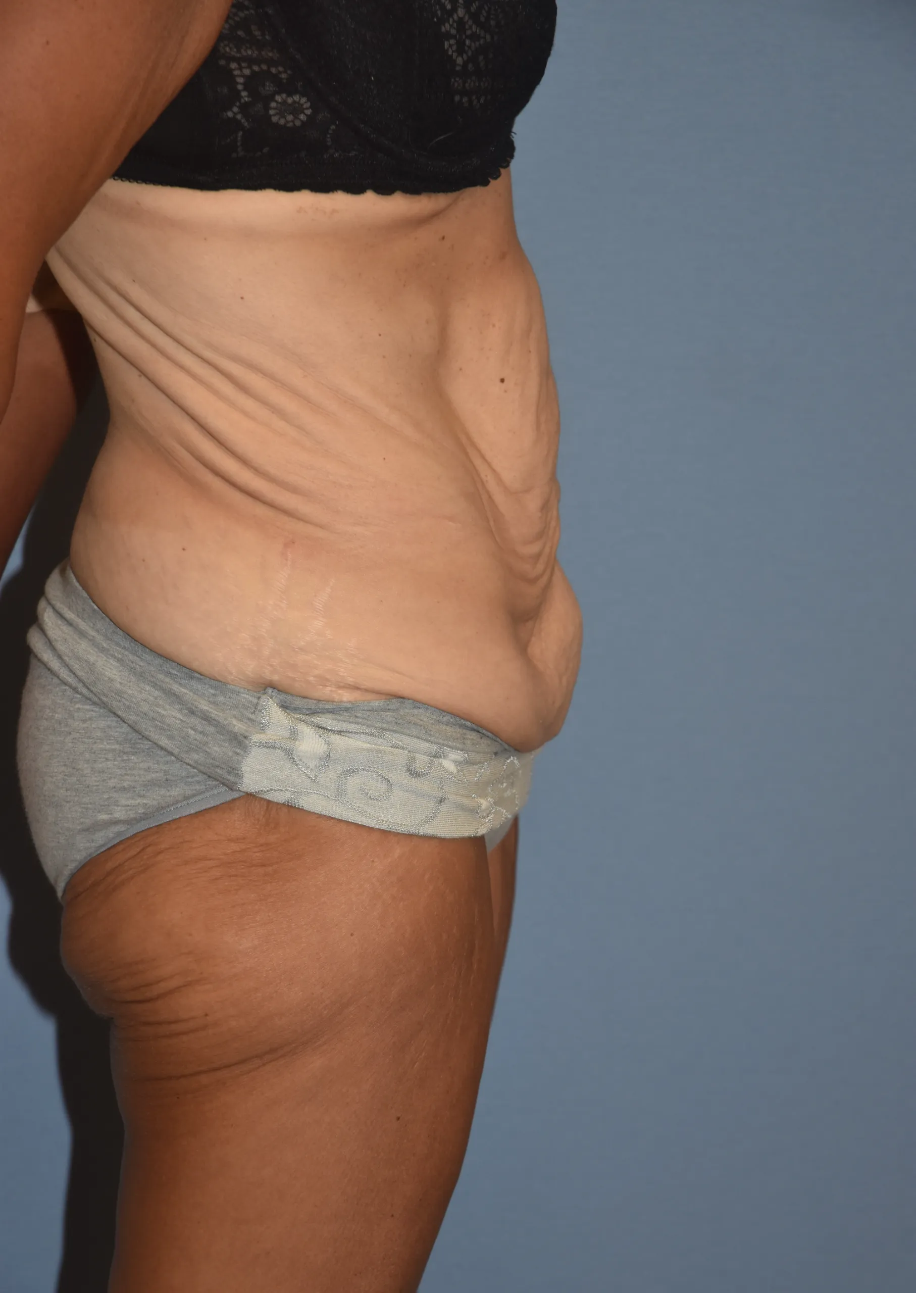 Before Fleur de Lis Tummy Tuck - side view