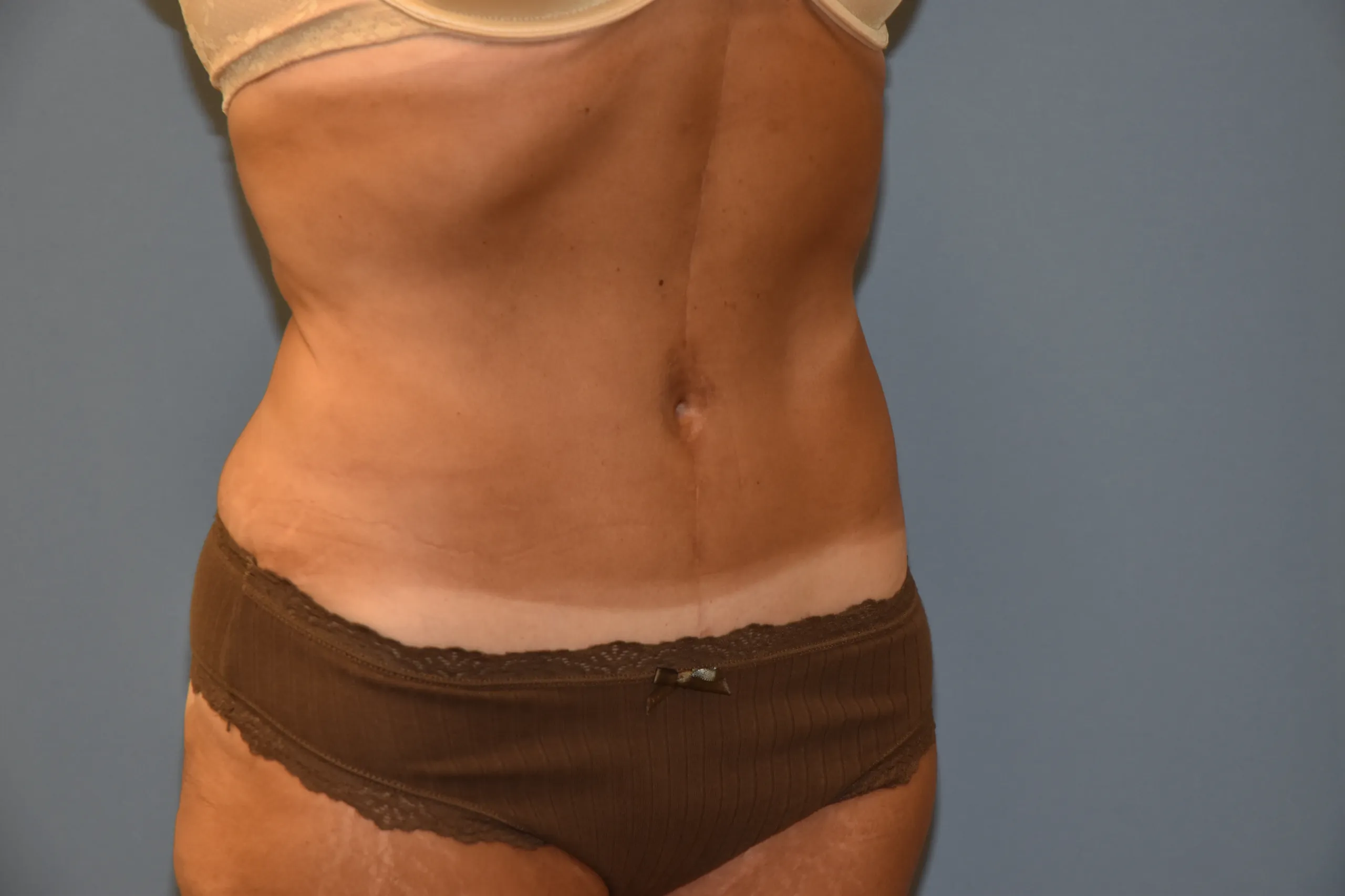 After Fleur de Lis Tummy Tuck - oblique view